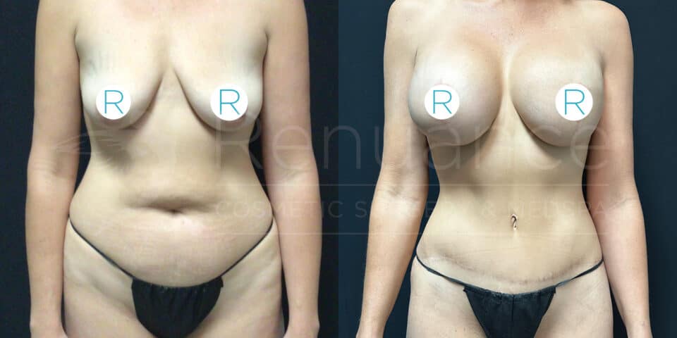 Before and after images of a person's torso, showing the results of cosmetic surgery. The person is wearing a black bikini bottom in both images. The left image displays the person's torso before the procedure, while the right image shows a more defined, enhanced torso after the procedure. Both images have markings on the chest area.