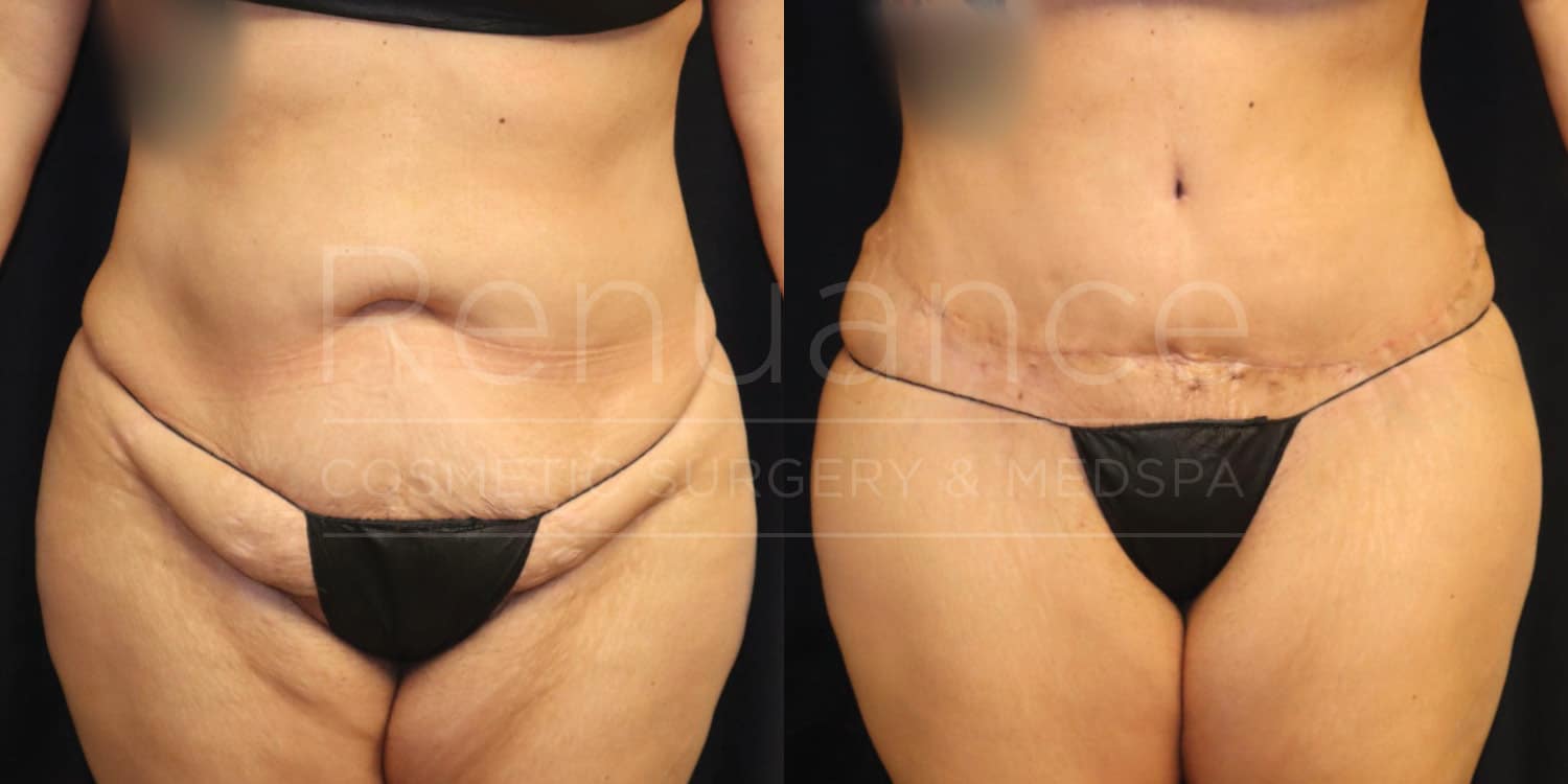 Before and after image of a person who has undergone a cosmetic body surgery. The left image shows the person's abdomen and upper thighs before the surgery, with visible loose and sagging skin. The right image shows the same area after the surgery, with a flatter and more toned appearance and a visible scar along the lower abdomen. The person is wearing a black undergarment in both images.