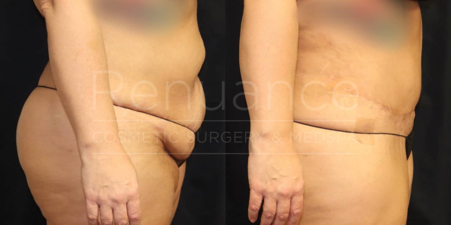 Before and after image of a person who has undergone a cosmetic body surgery. The left image shows the person's abdomen and upper thighs before the surgery, with visible loose and sagging skin. The right image shows the same area after the surgery, with a flatter and more toned appearance and a visible scar along the lower abdomen. The person is wearing a black undergarment in both images.
