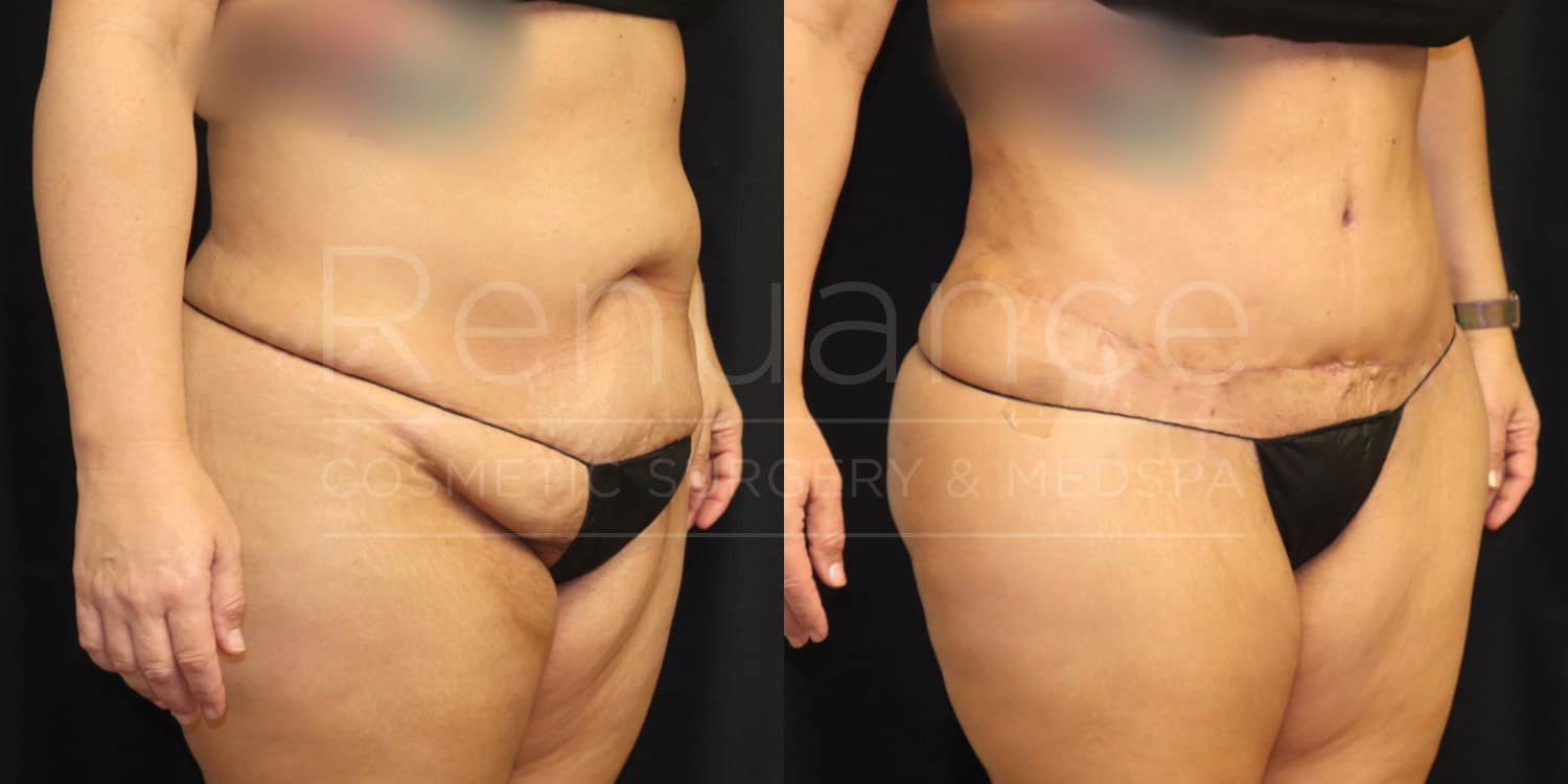 Before and after image of a person who has undergone a cosmetic body surgery. The left image shows the person's abdomen and upper thighs before the surgery, with visible loose and sagging skin. The right image shows the same area after the surgery, with a flatter and more toned appearance and a visible scar along the lower abdomen. The person is wearing a black undergarment in both images.