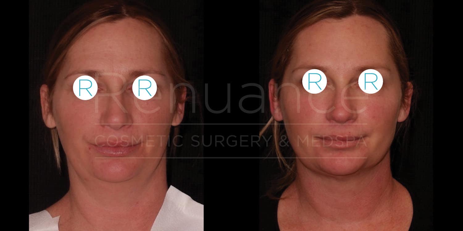 Side-by-side comparison image of a woman's face before and after a cosmetic procedure. The left side shows the woman before the procedure, and the right side shows her after the procedure. Both images have the woman's eyes obscured by circles labeled with "R." The background is black, and there is text in the middle that reads "Renuance Cosmetic Surgery & Medspa."