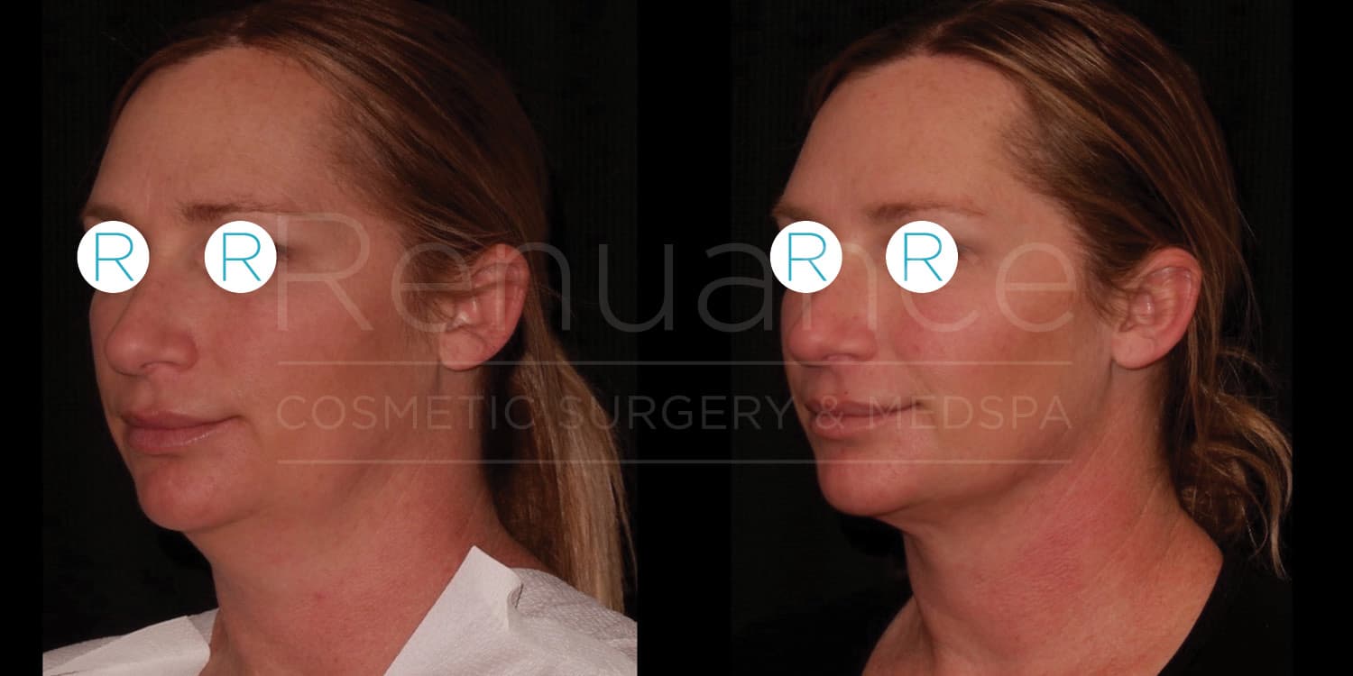 Two side-by-side images show a person's face in profile before and after cosmetic surgery. In the "before" image on the left, the individual has a double chin. In the "after" image on the right, the individual has a more defined jawline and chin. Both images have the person's eyes covered with circles marked "R." The background is dark in both images. The text "Renuance COSMETIC SURGERY CENTER & MEDSPA" is overlayed across the images.