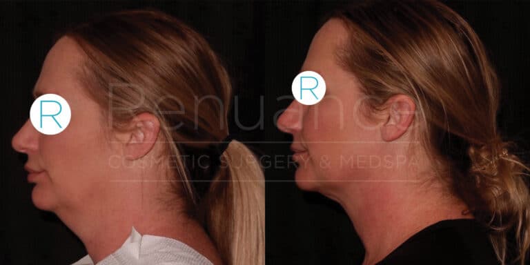 Side-by-side comparison of a woman's profile before and after a cosmetic procedure. The image on the left shows the profile before the procedure, with excess skin and fat under the chin. The image on the right shows the profile after the procedure, with a more defined jawline and reduced fat under the chin. Both images have the woman's eyes censored with a letter "R".