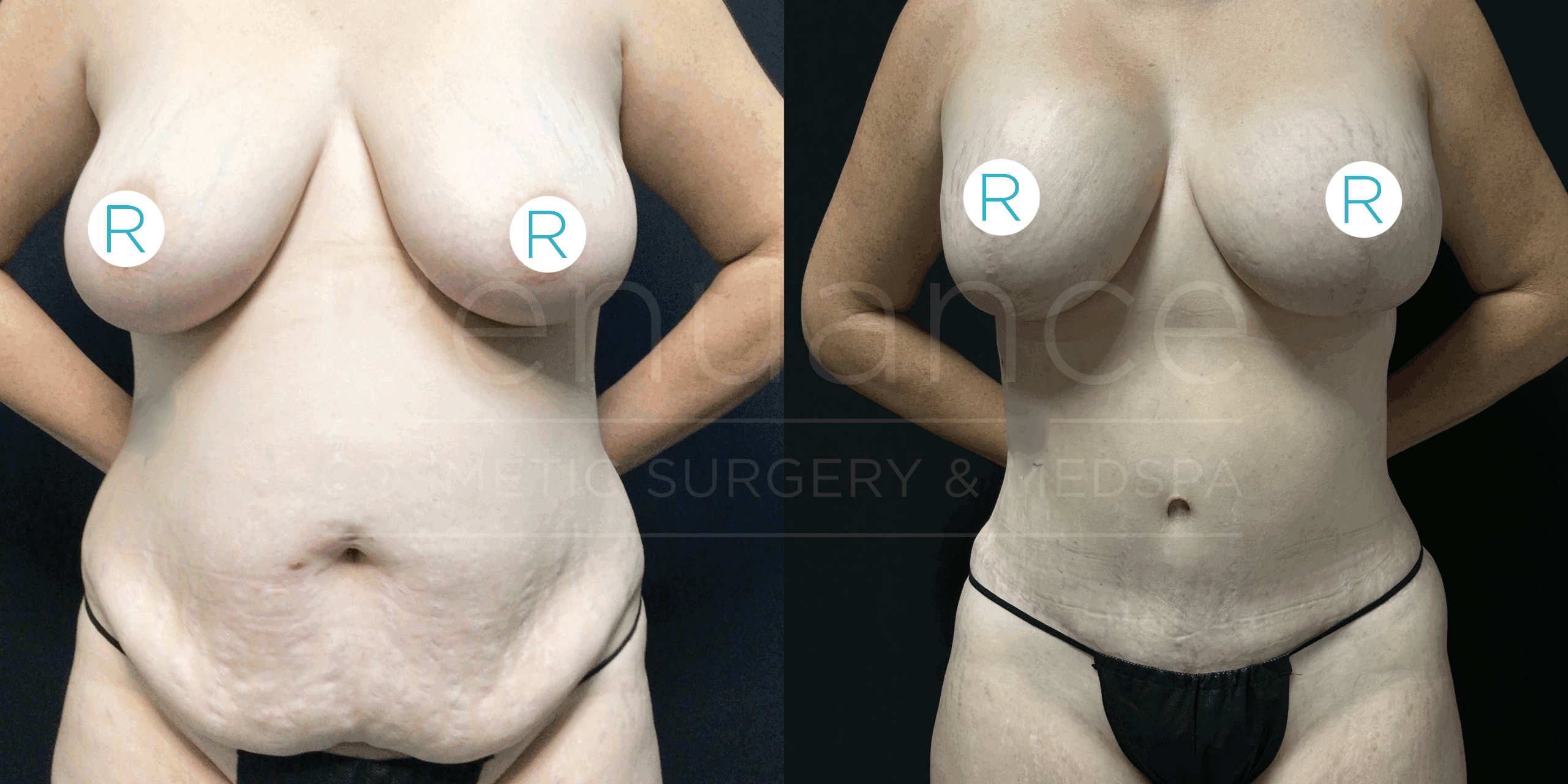 A side-by-side comparison image showing the front view of a person's torso before and after cosmetic surgery. On the left, the person has more prominent sagging skin and excess tissue around the abdomen and breasts. On the right, the person's abdomen appears flatter and more toned, and the breast area is also more uplifted and firm. The nipples are covered with circles labeled "R."