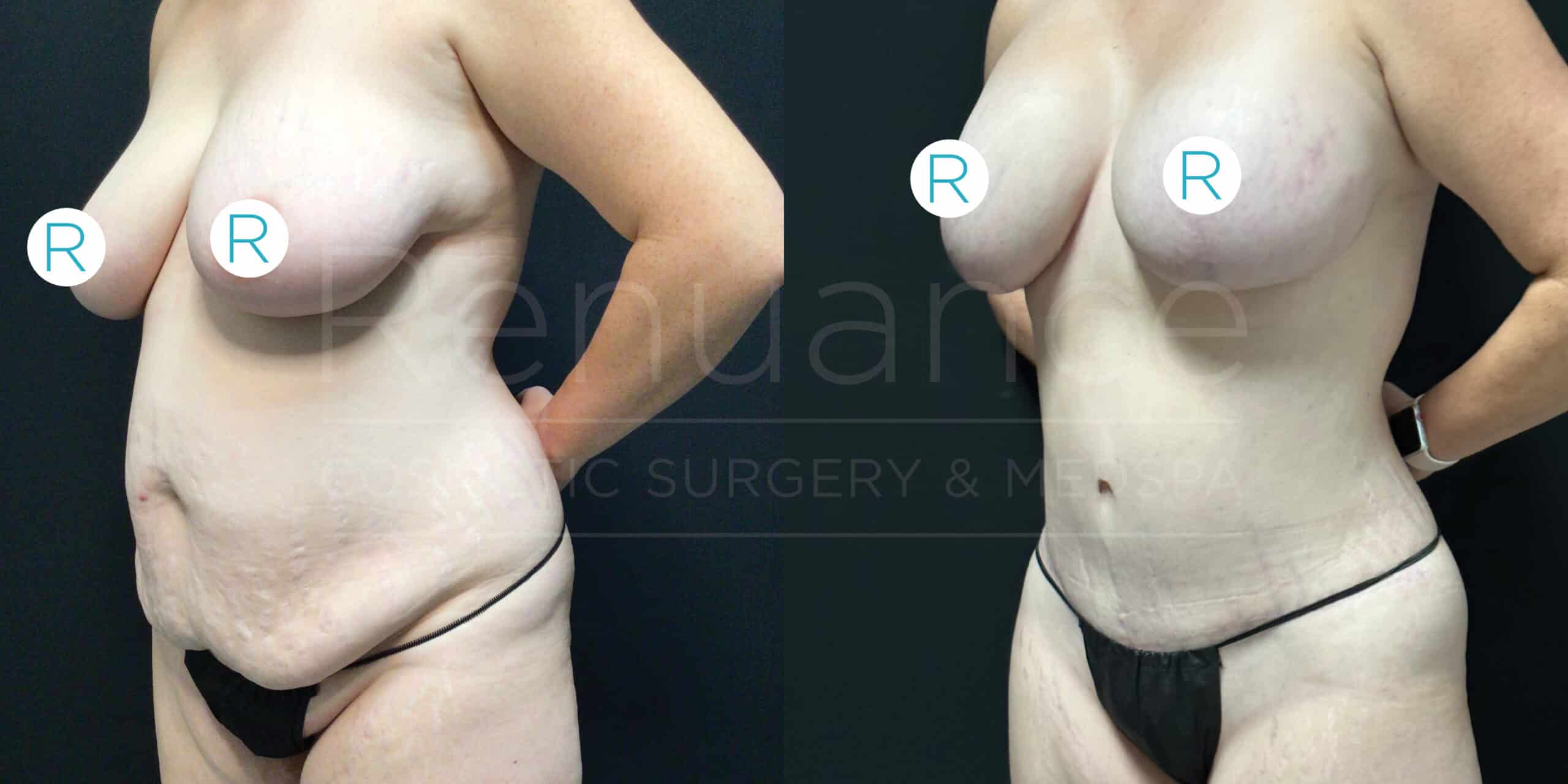 Two side-by-side images show a woman before (left) and after (right) undergoing cosmetic surgery. The left image shows a woman with loose skin and sagging in the abdominal and breast areas, while the right image shows a more toned abdomen and lifted breasts. She is standing against a black background in both images, with her hands on her hips. The letter "R" is marked on the right side of her body in both images.