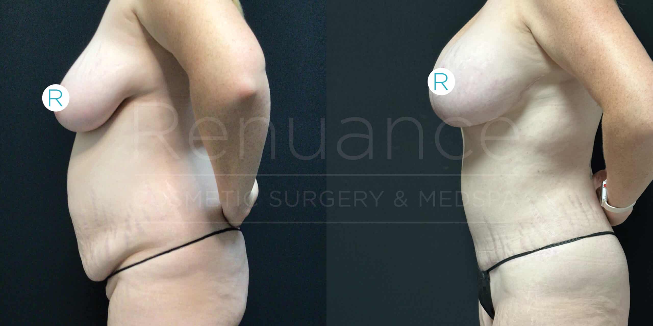 Side-by-side comparison photographs show the side profile of a person before and after an abdominal cosmetic surgery. The first image on the left shows the person with a more prominent and protruding abdomen. In the second image on the right, the person's abdomen appears flatter and more toned. Both images are marked with an "R" on the shoulder to indicate the right side of the body.