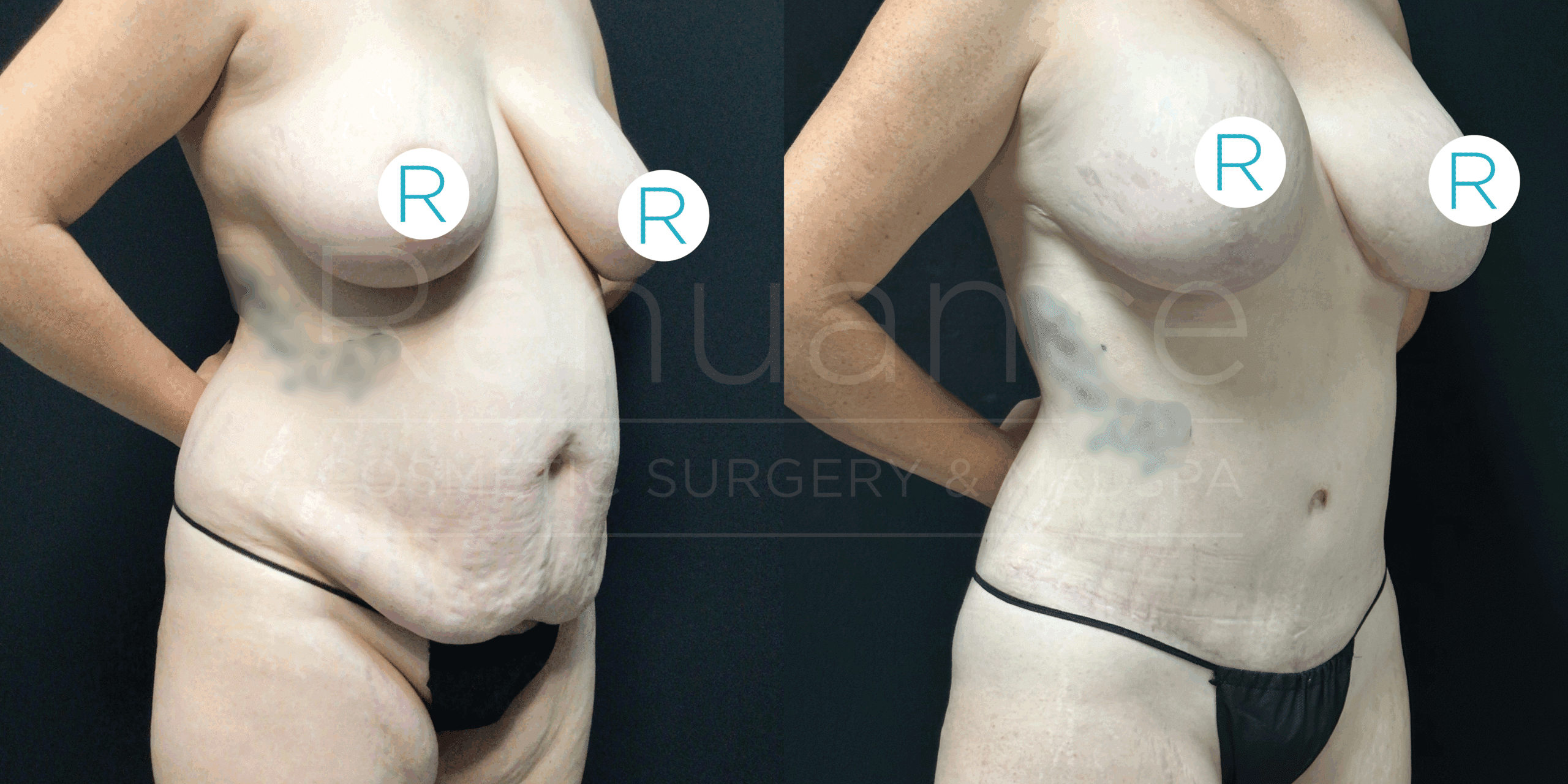 Alt Text: "Side-by-side comparison of a woman's body before and after cosmetic surgery. The left image shows the body before surgery with noticeable excess skin and sagging in the abdominal area. The right image shows the body after surgery with a tighter, more toned appearance in the same area. Both images have a circular opacity on one of the breasts with an 'R' label on it."