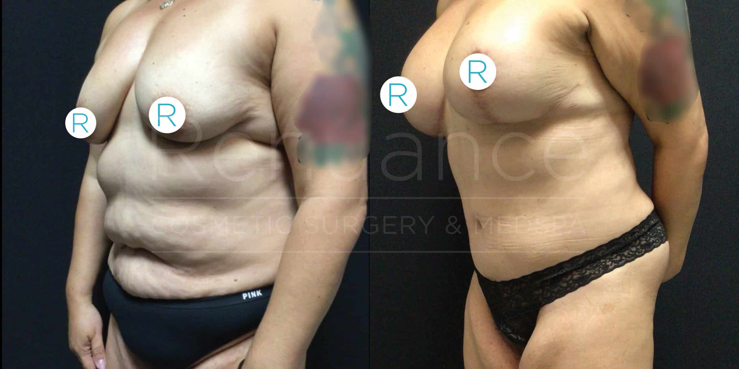 A side-by-side comparison of a person before and after undergoing cosmetic surgery. The individual is wearing a black undergarment in both photos. In the "before" photo on the left, the person has pronounced abdominal and chest features. In the "after" photo on the right, the individual appears to have a more sculpted and toned abdomen and chest. Both images are labeled with a "R" indicating the right side.