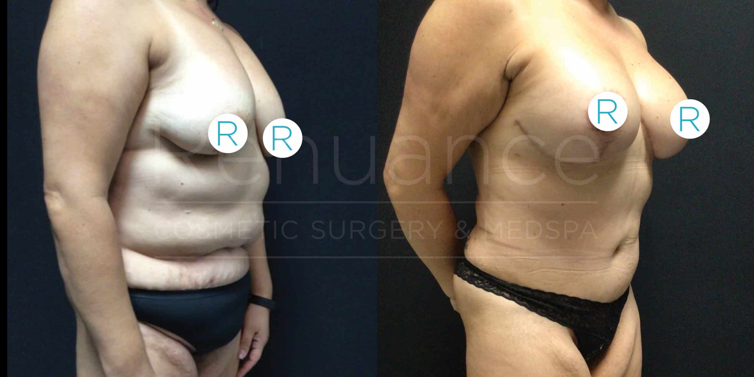 The image shows a before-and-after comparison of a person’s torso and arms following cosmetic surgery. The before image on the left depicts the person in black underwear with visible excess skin and fat around the abdomen and fuller breasts. The after image on the right shows the same person with a notably reduced abdomen and more contoured, lifted breasts. Both images are taken from a side angle.