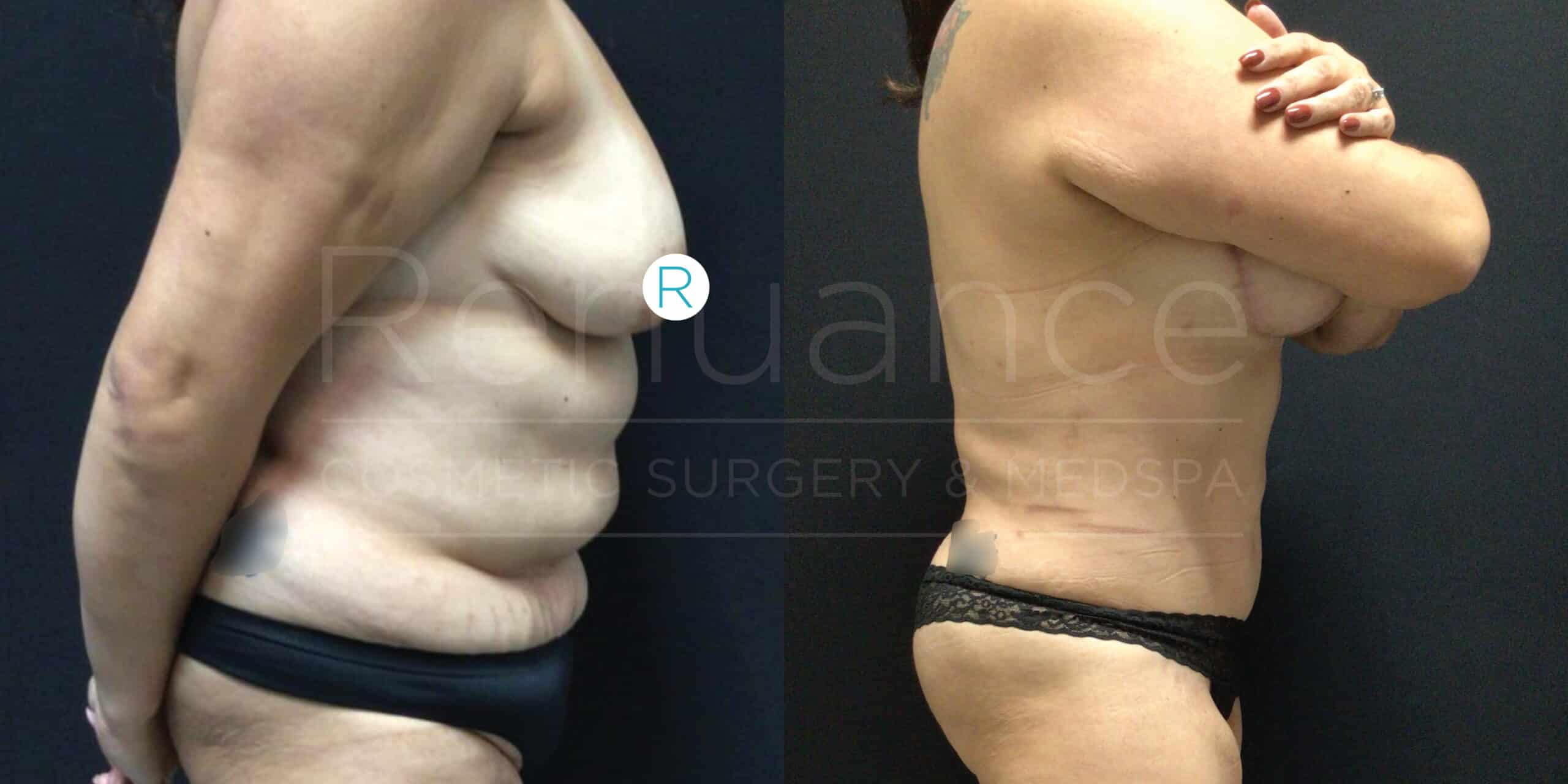 Side-by-side images showing a woman's torso before and after a cosmetic procedure. The left image shows the woman with noticeable excess skin and fat in her midsection, while the right image shows a significant reduction in skin and fat, resulting in a smoother and more toned appearance. The woman is wearing a black undergarment in both images.