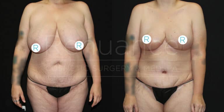 Before and after images of a woman who underwent cosmetic surgery. The images show the front view of her upper body. In the first image, taken before surgery, the woman has larger breasts and a less defined waistline. In the second image, taken after surgery, she has noticeably smaller, more lifted breasts and a more contoured waistline. Both images are set against a black background.