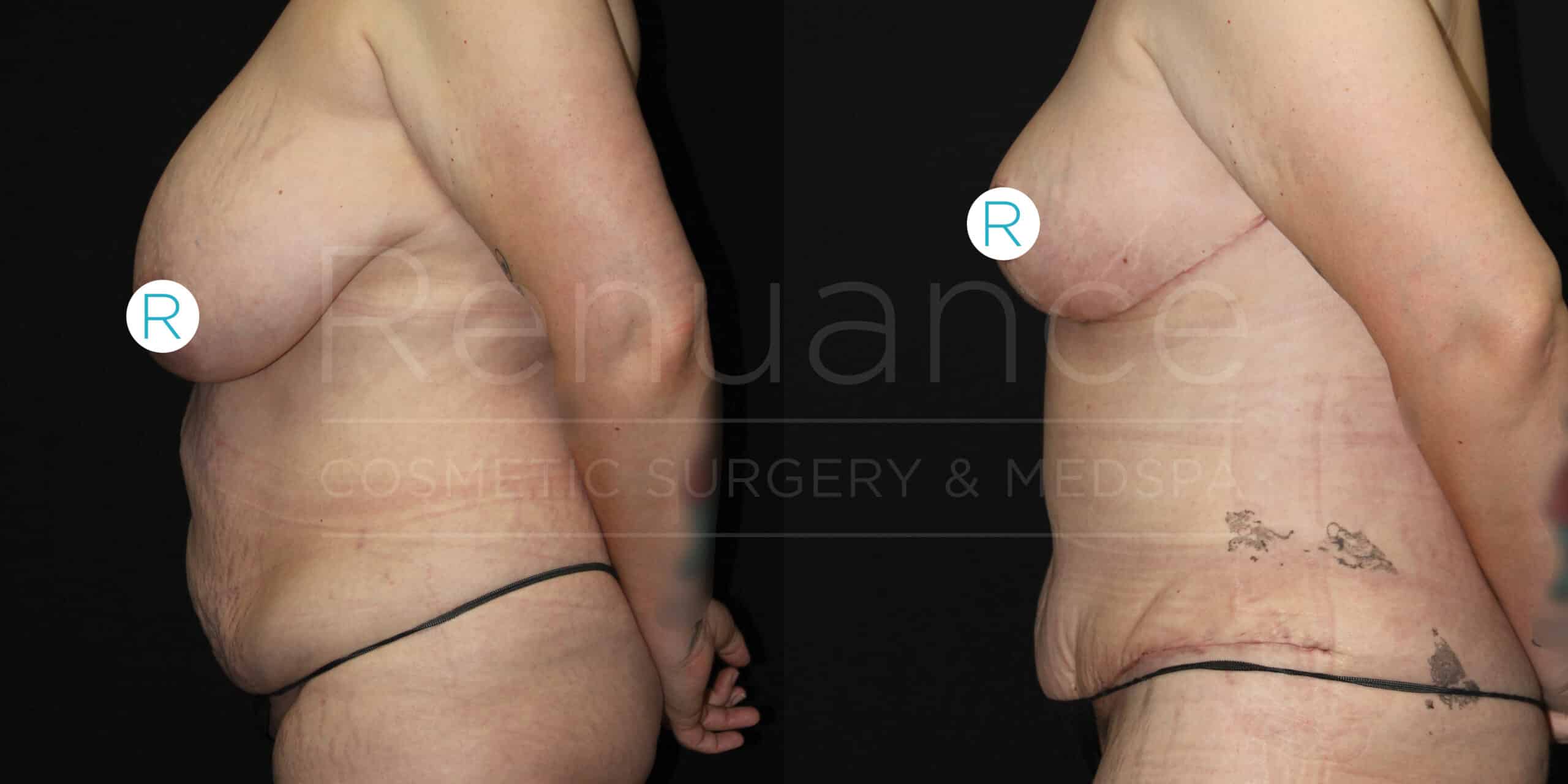 Side-by-side before and after photos of a person who has undergone a cosmetic surgical procedure. In the left image, the person has a larger breast and abdomen, while in the right image, the same person shows a flatter chest and abdomen with visible surgical marks, indicating a significant reduction in size. The images are labelled with "R" to denote the right side and have the text "Renuance Cosmetic Surgery & Medspa" in the background.