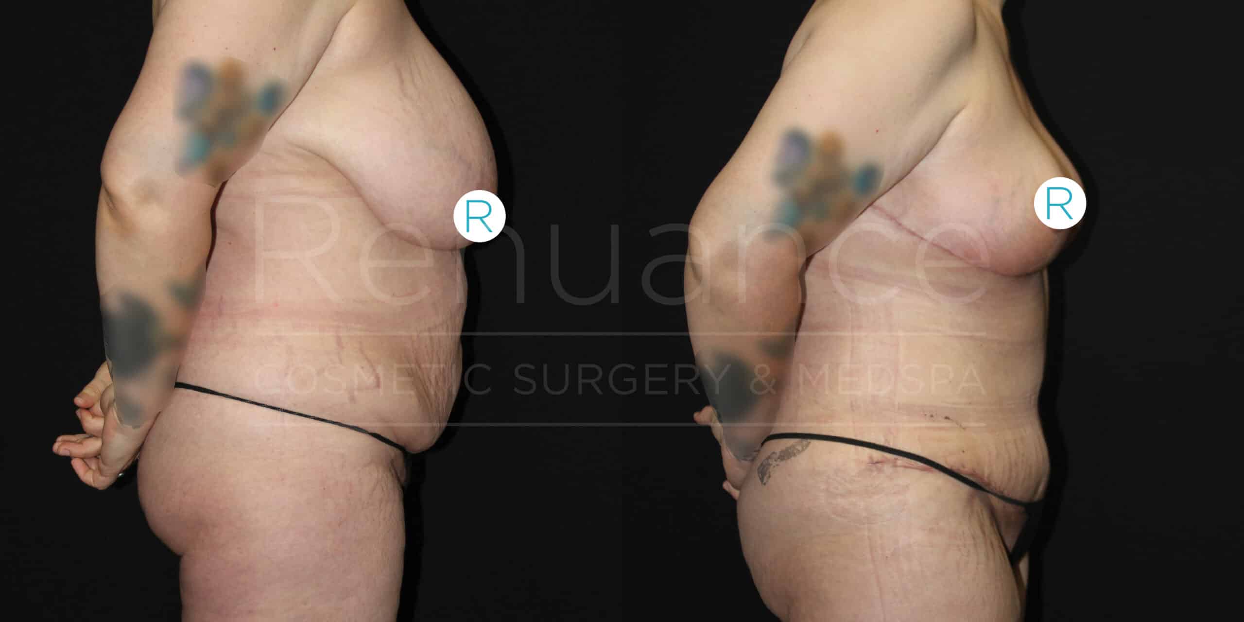 Two side-by-side images show before and after results of a cosmetic surgery performed on a person's torso. The left image shows the "before" state with the person having more abdominal fat and sagging skin. The right image depicts the "after" state with a noticeably slimmer and toned abdomen, as well as lifted and firmer skin. The person's face is not visible, and they are wearing black underwear in both images. There is an "R" marker indicating the right side of the body. The