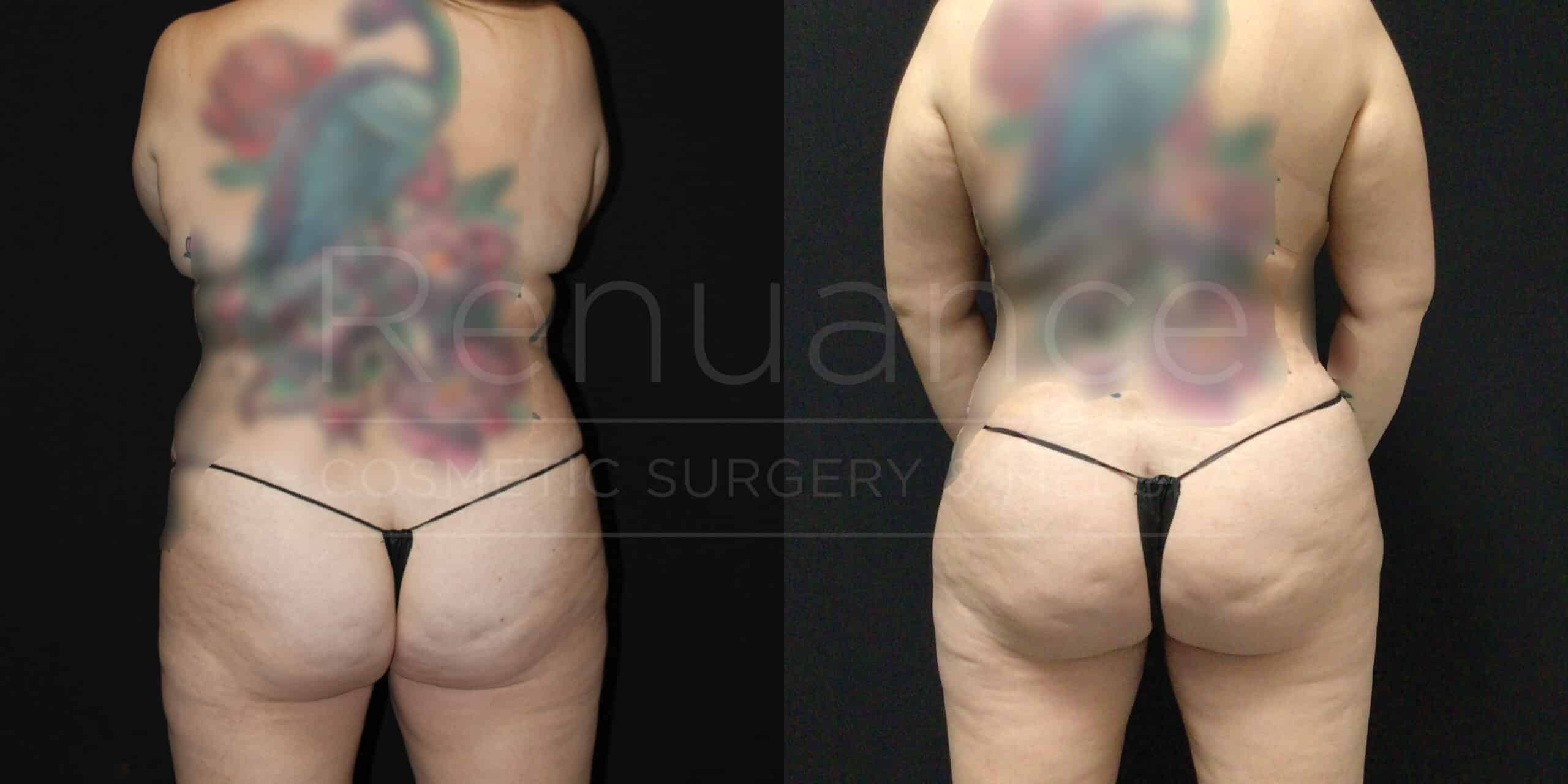 Side-by-side images of a person's back before and after cosmetic surgery. The individual has a large, colorful tattoo on the back that is blurred. In the "before" image on the left, there are visible areas of excess skin and fat. The "after" image on the right shows a smoother, more contoured appearance. The person is wearing minimal clothing in both images. The words "Renuance Cosmetic Surgery" appear faintly over both images.