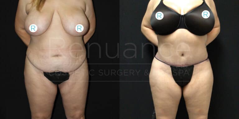 The image shows a side-by-side comparison of a woman's body before and after a cosmetic procedure. The left image is the "before" photo, depicting the woman with bare torso and lower body covered with black undergarments. The right image is the "after" photo, showing the woman in a black bra and black undergarments. There are noticeable changes in her body shape and size between the two images. The background is black and has text that appears faded.