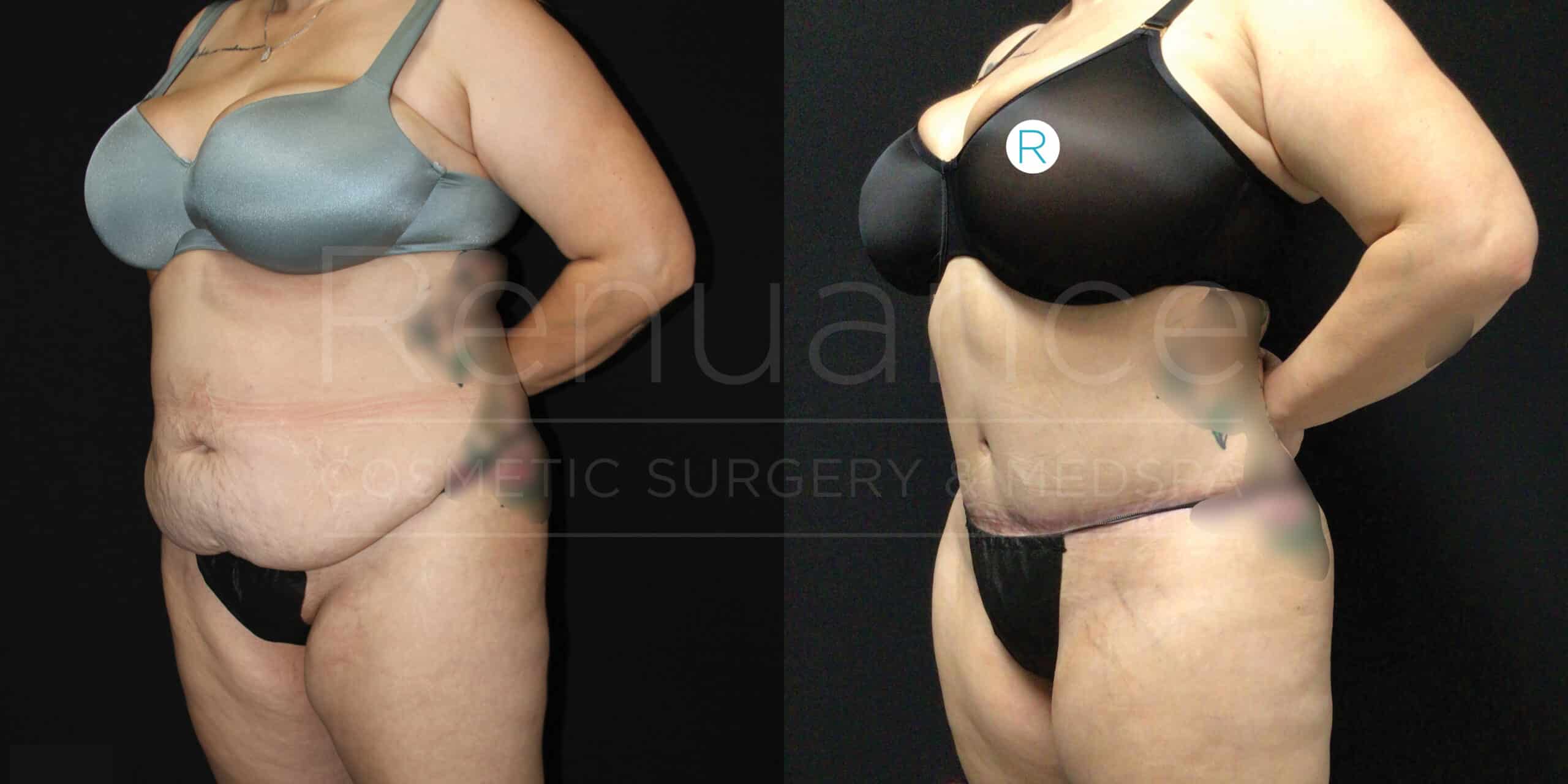Before and after images of a woman showcasing the results of a cosmetic surgery procedure. The first image on the left shows her torso before the procedure, while the second image on the right shows her torso after the procedure. She is wearing a bra and underwear in both images. The after image depicts a flatter and more contoured abdomen.