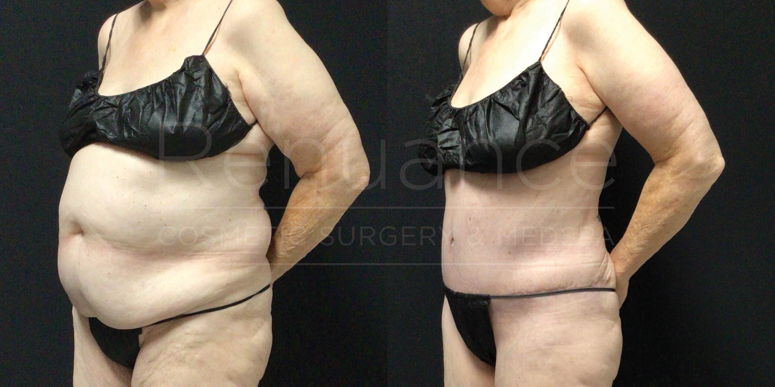 Before and after showing tummy tuck with liposuction and arm lift improvements