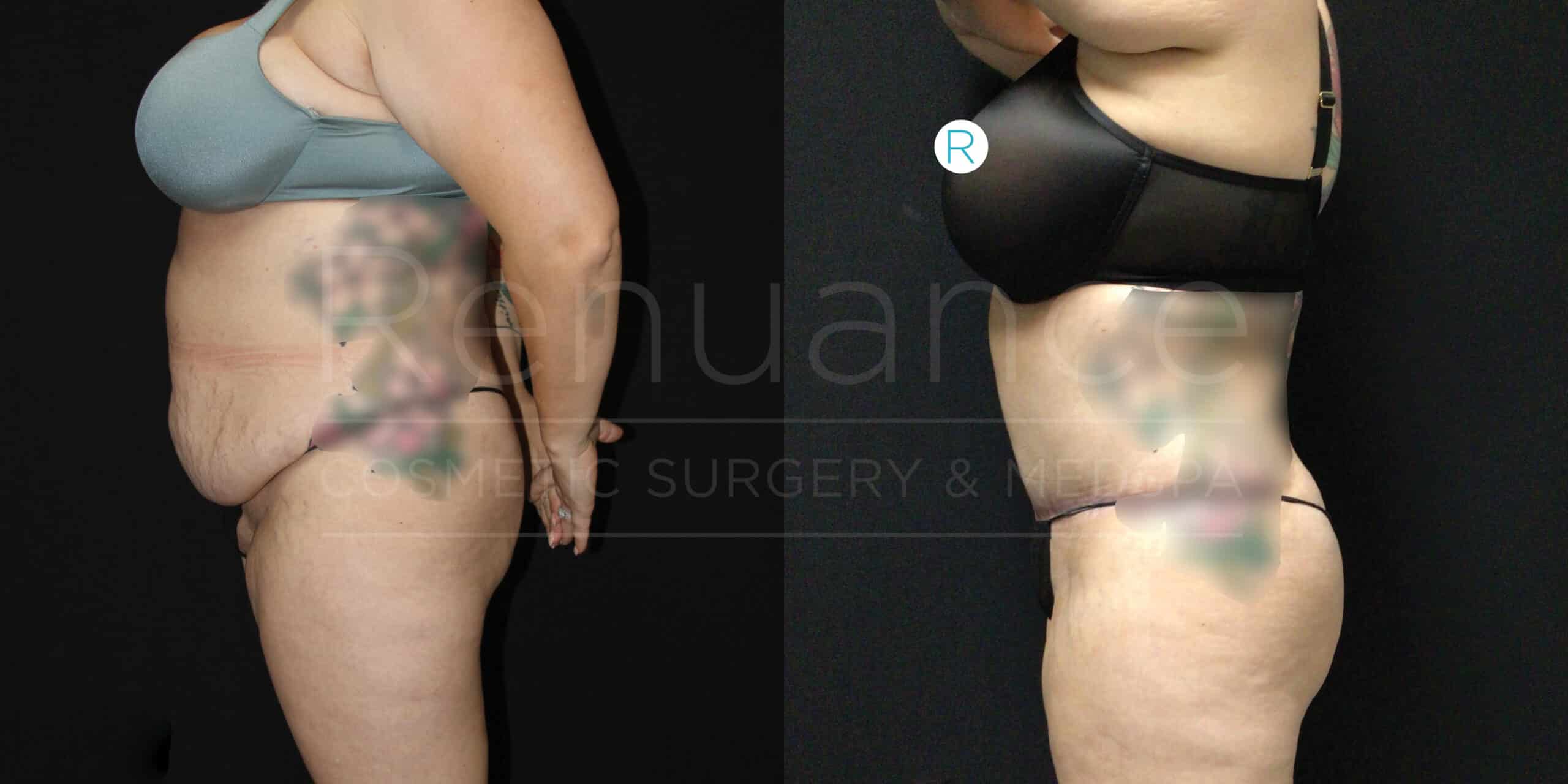 A side-by-side comparison image showing the before and after results of a cosmetic surgery procedure. The left side of the image depicts a person with excess abdominal skin and fat, wearing a teal bra. The right side shows the same person after the procedure, with a slimmer and more toned abdomen, wearing a black bra. The background is black in both images.
