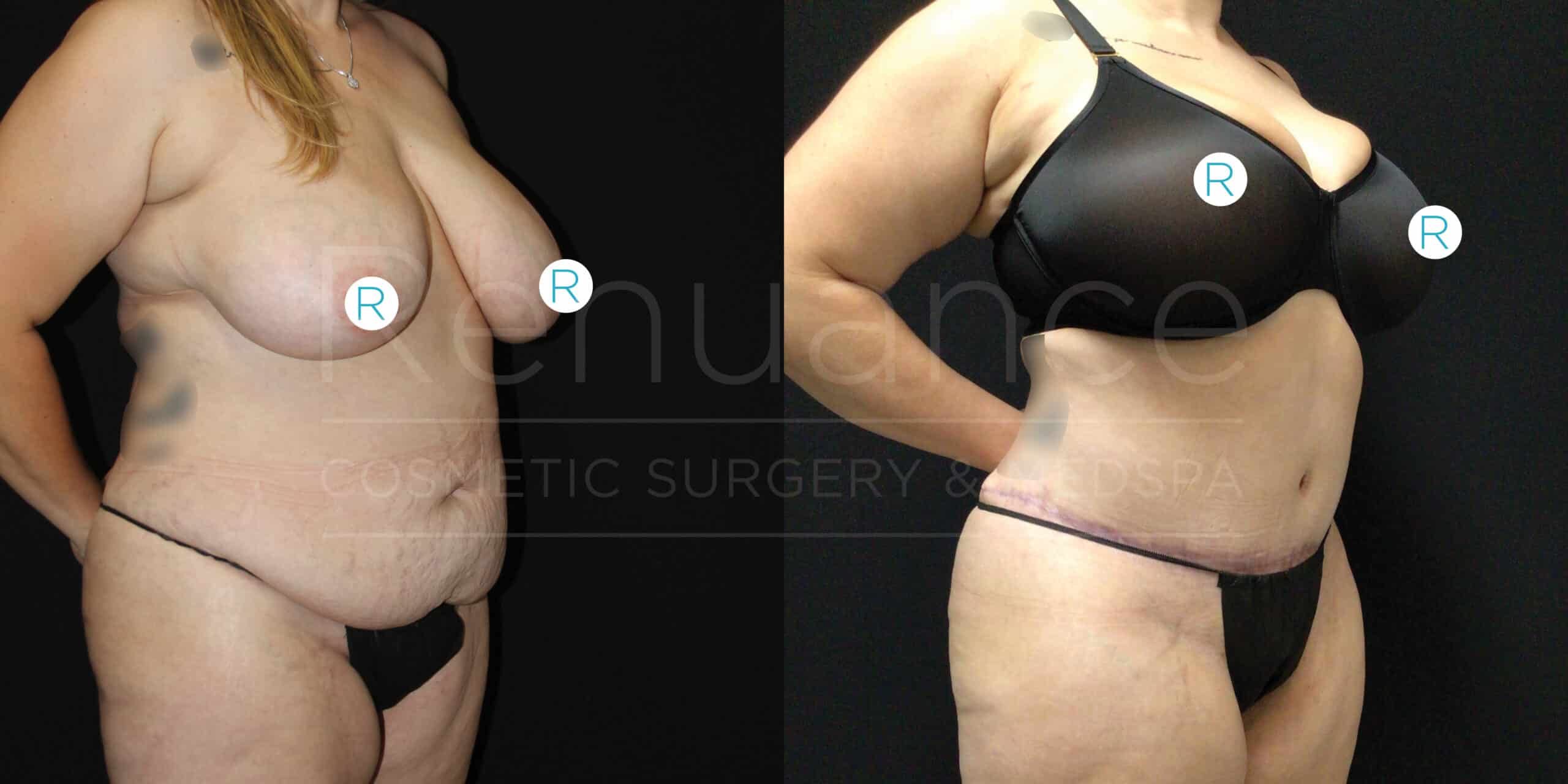 Side-by-side comparison of a woman's body before and after cosmetic surgery. The left image shows the woman with sagging breasts, loose abdominal skin, and a visible stomach. The right image shows the same woman post-surgery, with lifted breasts, a smoother abdomen, and a trimmer waistline. The woman is wearing a black bra and underwear in both images.