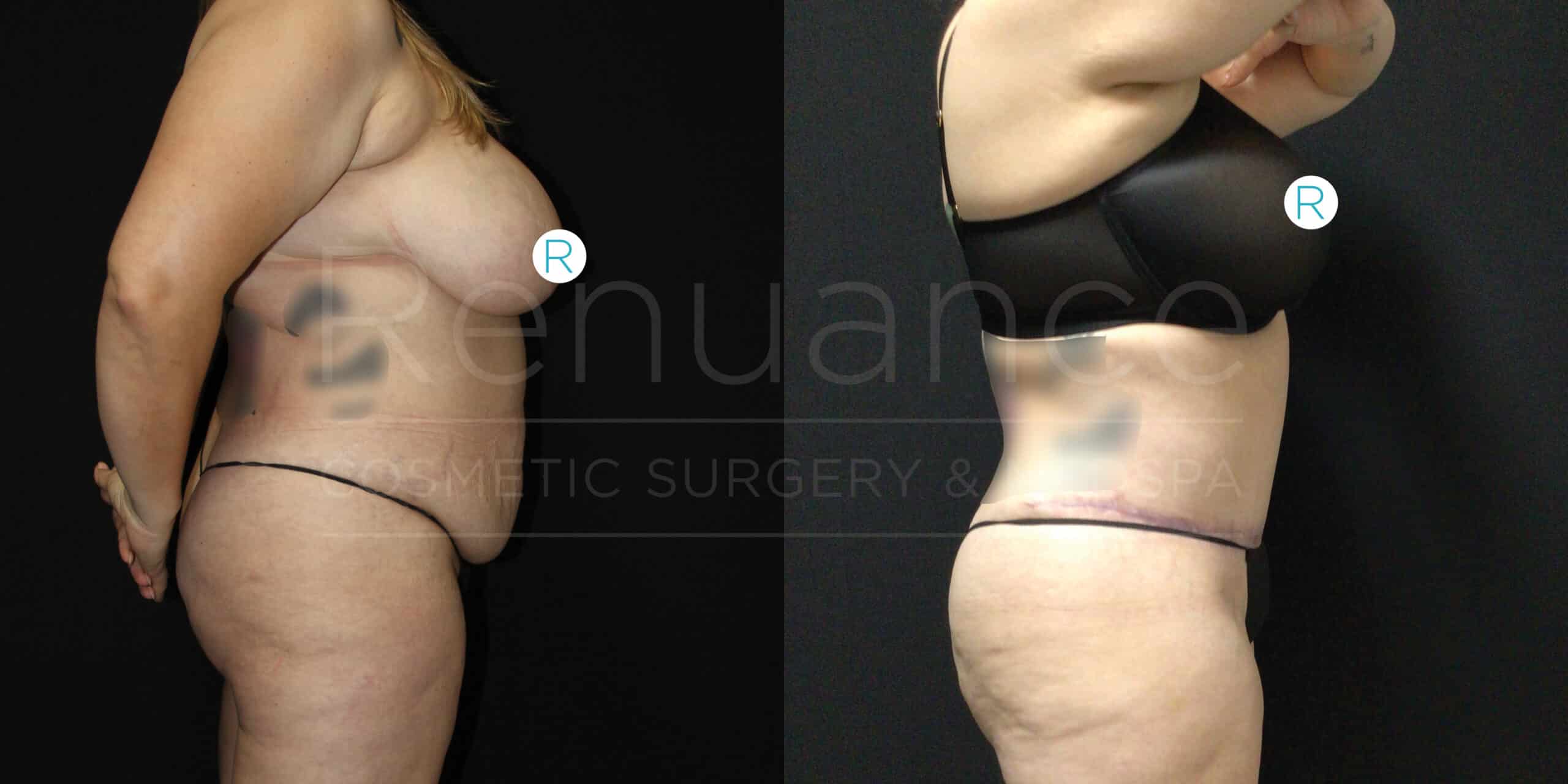 Side-by-side comparison of a person's body before and after liposuction and tummy tuck surgery. The left image shows the person with more excess skin and fat around the abdomen, while the right image shows a significant reduction in the abdominal area, with a flatter and more toned appearance. The person is wearing a black bra and underwear in both images.