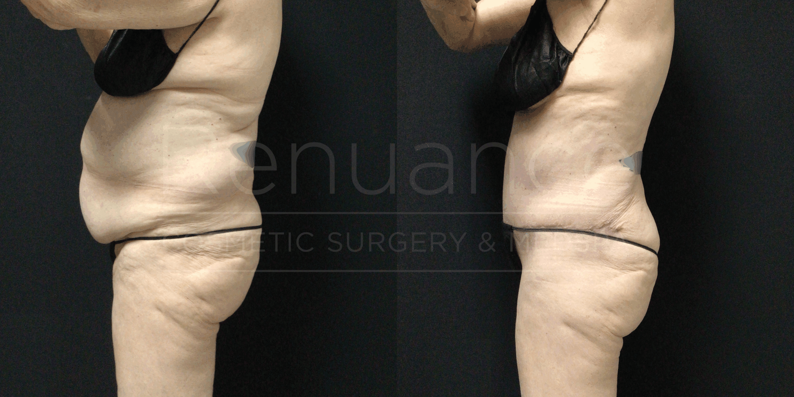 Tummy tuck, liposuction and arm lift before and after showing total body contouring