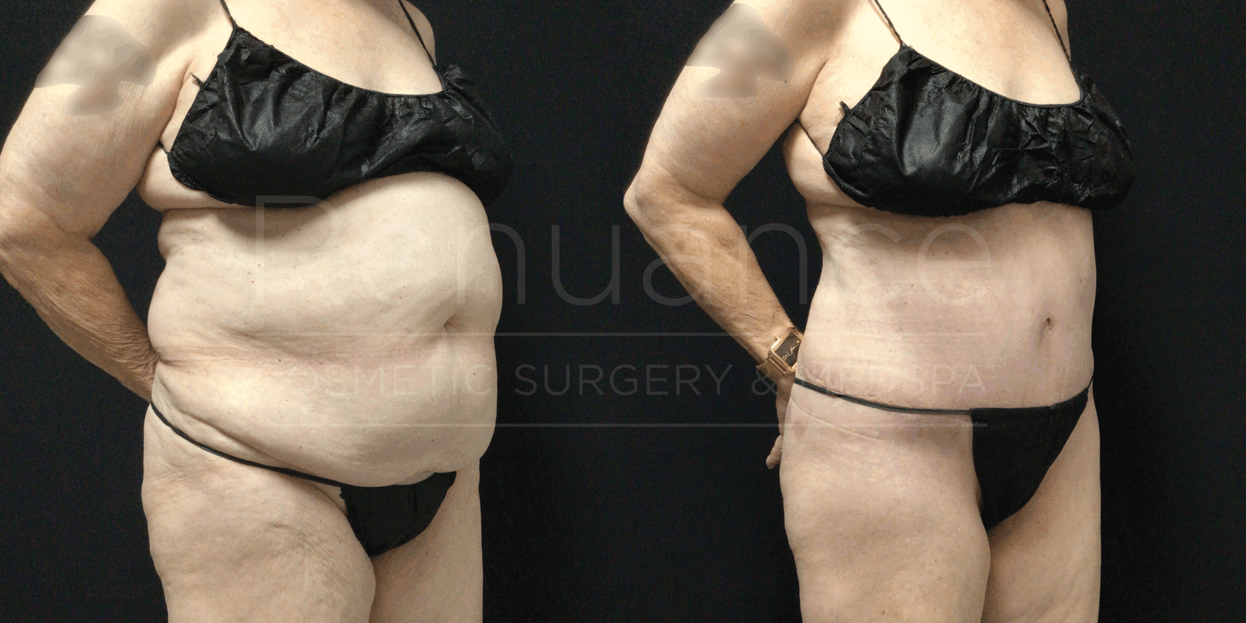 A before-and-after image showing two side-by-side views of a person wearing black undergarments. The left view depicts the person before undergoing a cosmetic procedure, with more pronounced abdominal and thigh areas. The right view shows the same person after the procedure, with a noticeably slimmer abdomen and thighs.