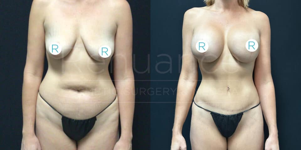 "Before and after image showing the front view of a person who has undergone cosmetic body surgery. The left half shows the person before the surgery, and the right half shows the person after the surgery. Noticeable changes include alterations to the abdominal and breast areas."