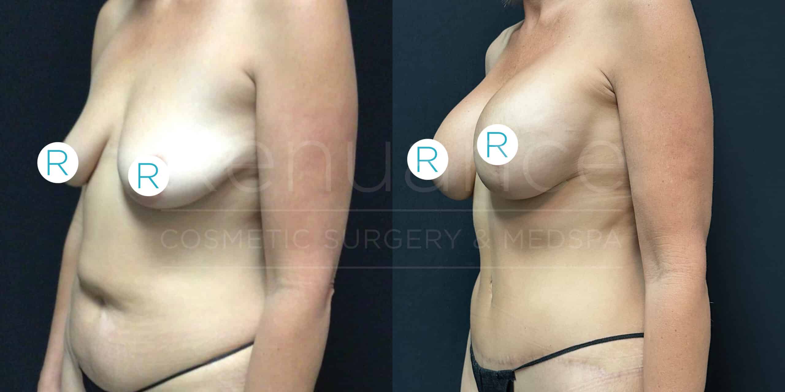 Side-by-side comparison of two images showing a woman's upper body before and after cosmetic surgery. The left image shows her breasts appearing smaller and sagging, while the right image shows her breasts appearing fuller and more lifted. She is wearing a black undergarment in both images.
