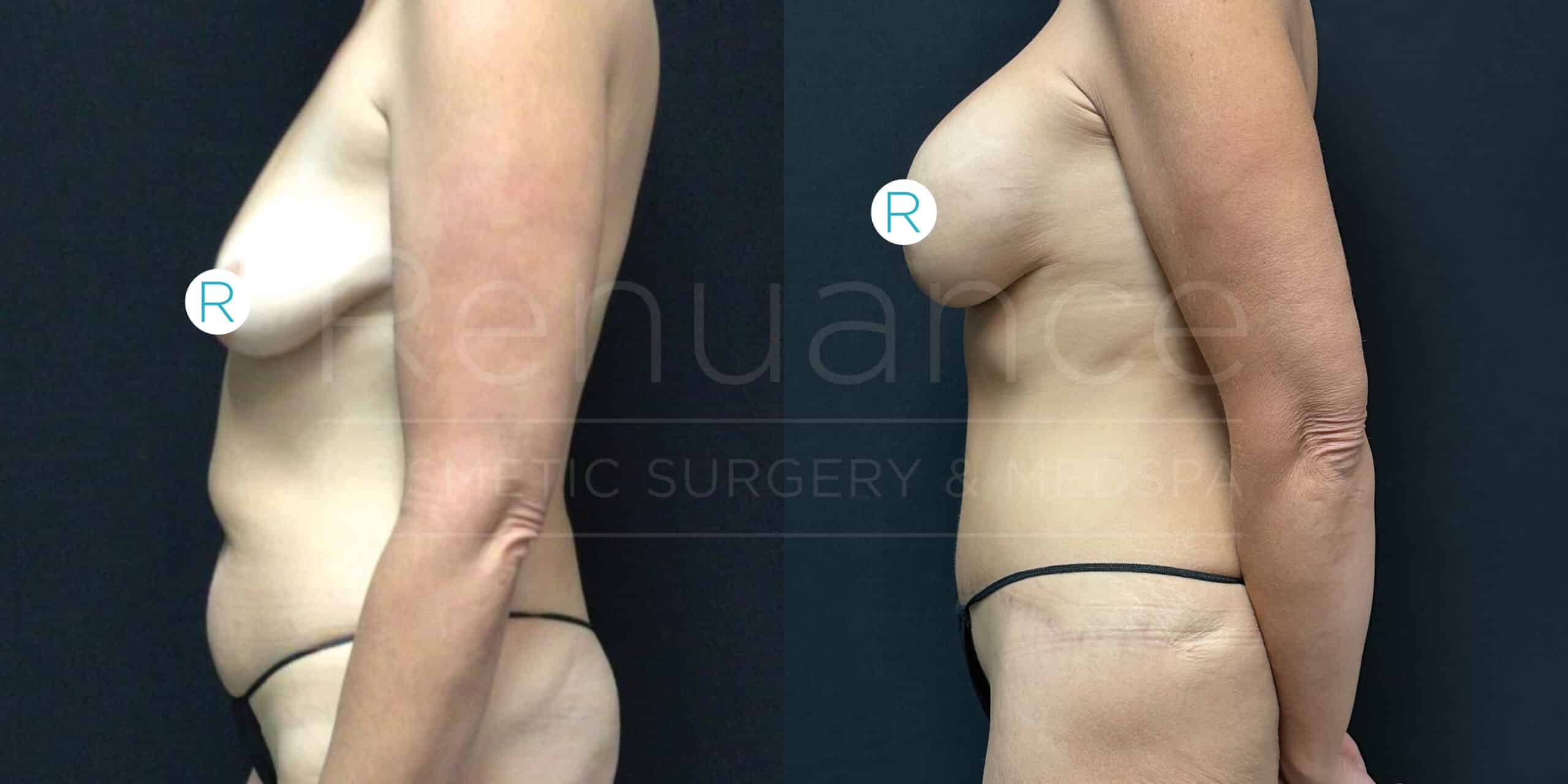 Side-by-side comparison of a woman's upper body showing the results of a breast lift. The left image shows the body before the procedure, with sagging breasts. The right image shows the body after the procedure, with lifted and firmer breasts. Both images have the letter "R" placed on the breast area. The woman is wearing black underwear. The background is black in both images with a faint watermark reading "Renuance Cosmetic Surgery & Med Spa."