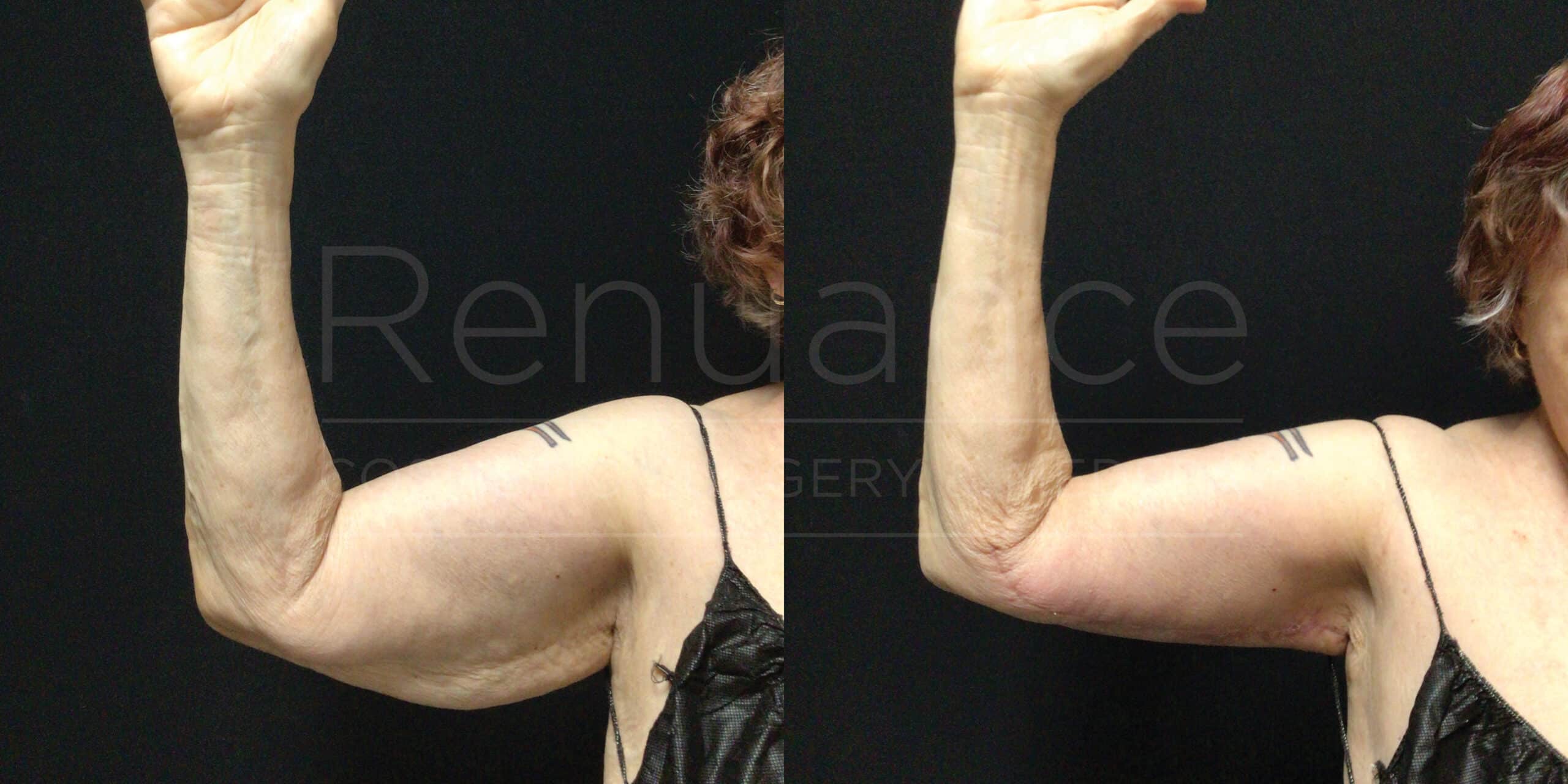 A comparison image showing the before and after results of an arm lift surgery. The left side of the image shows a person's arm prior to the procedure, displaying loose and sagging skin. The right side of the image shows the arm after the surgery, with tighter and more toned skin. The person's arm is raised in both images, and the background is black.