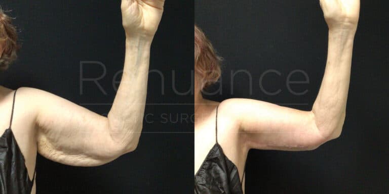 Side-by-side comparison of a person's left arm before and after a cosmetic procedure to improve the appearance of loose, sagging skin. The left image shows the arm raised with visible loose skin, while the right image shows the same arm with tightened, smoother skin. Both images have a black background and only the upper part of the arm is visible.
