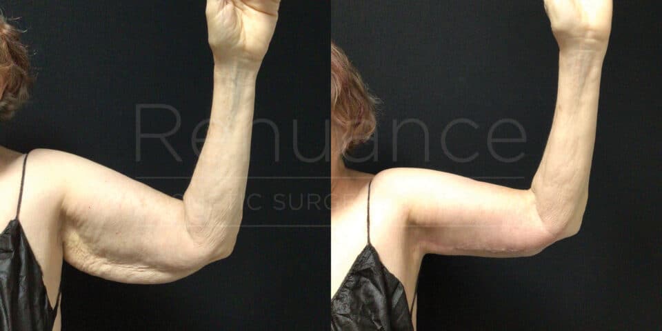 Side-by-side comparison of a person's left arm before and after a cosmetic procedure to improve the appearance of loose, sagging skin. The left image shows the arm raised with visible loose skin, while the right image shows the same arm with tightened, smoother skin. Both images have a black background and only the upper part of the arm is visible.