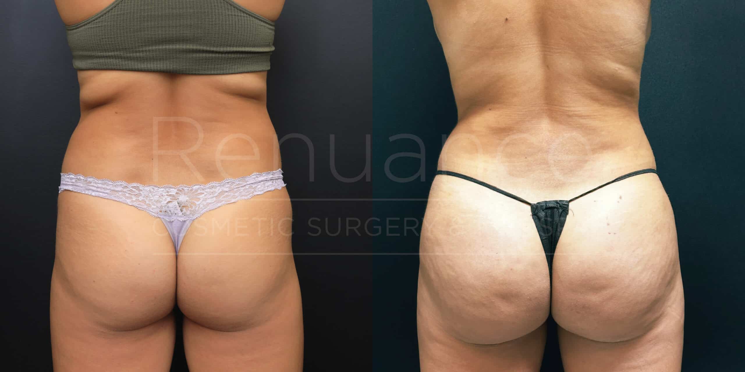 A side-by-side comparison of two images showing the lower back and buttocks of a person before and after a cosmetic surgery procedure. The image on the left shows the person wearing gray underwear, with some visible cellulite and less sculpted appearance. The image on the right shows the same person wearing black underwear, with a smoother skin texture and more contoured, toned appearance. Both images have the words "Renuance Cosmetic Surgery" overlaid in the center.