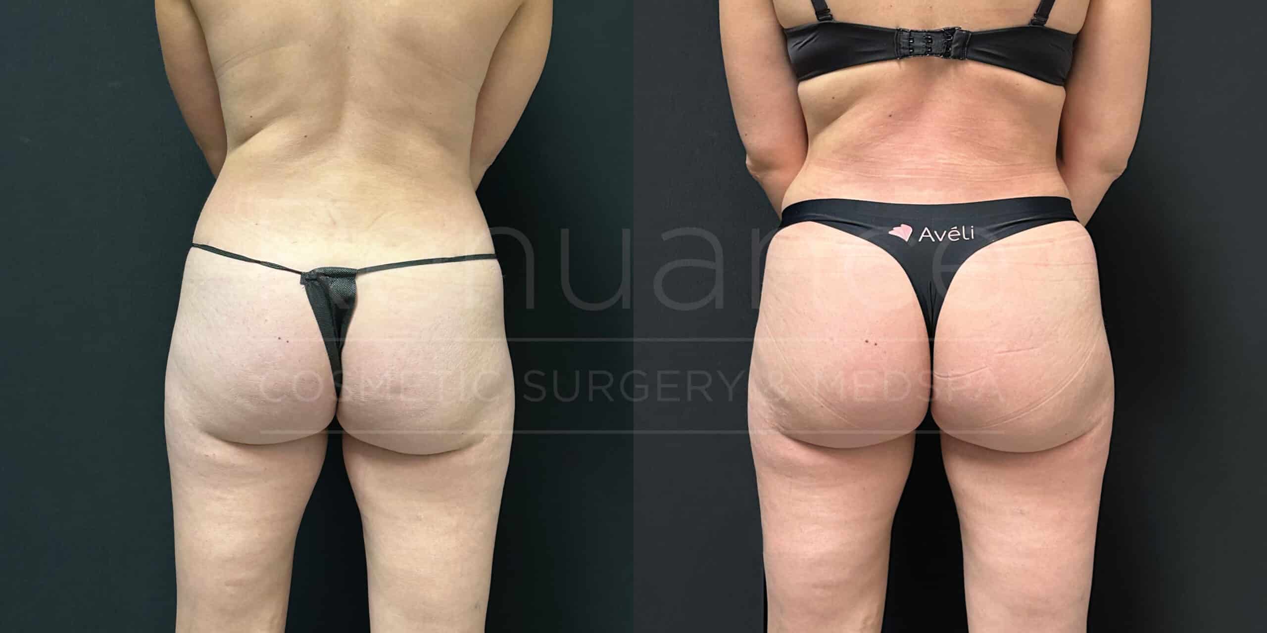 Before and after image showing the results of a cosmetic surgery procedure on a person. On the left, the person has more visible cellulite on the buttocks and upper thighs, and on the right, the skin appears smoother with reduced cellulite. The person is wearing minimal clothing in both images to highlight the changes.