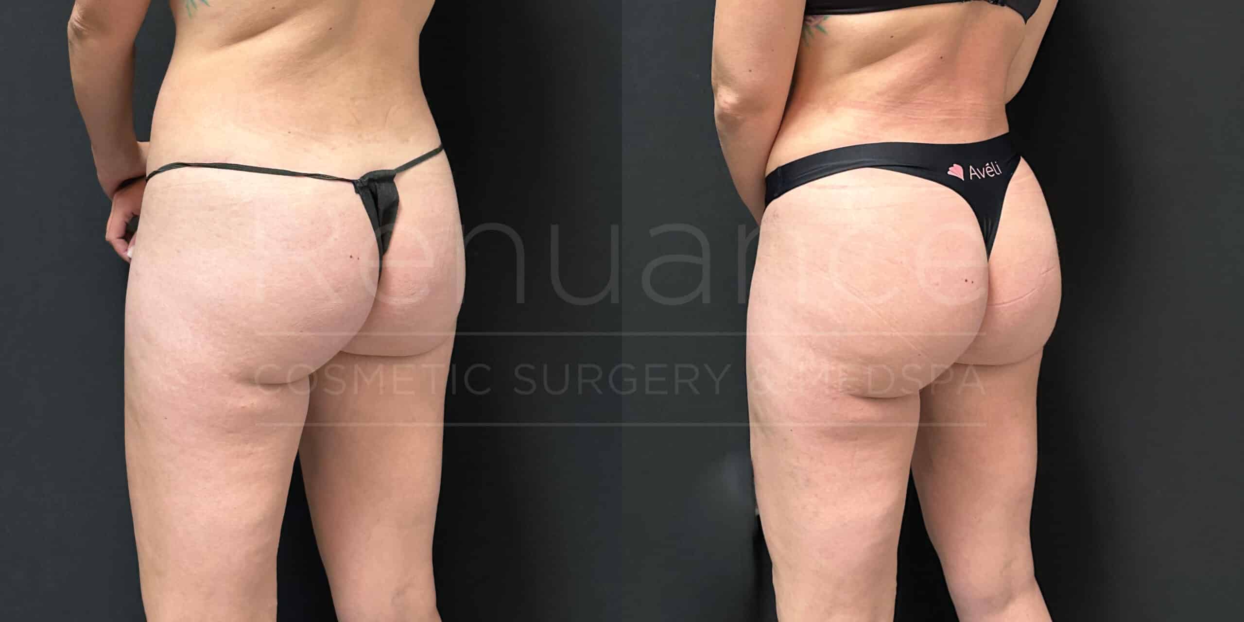 Side-by-side comparison of a woman's lower body before and after a cosmetic procedure. The images show her wearing minimal black underwear, with noticeable changes in the appearance of her buttocks and upper thighs.