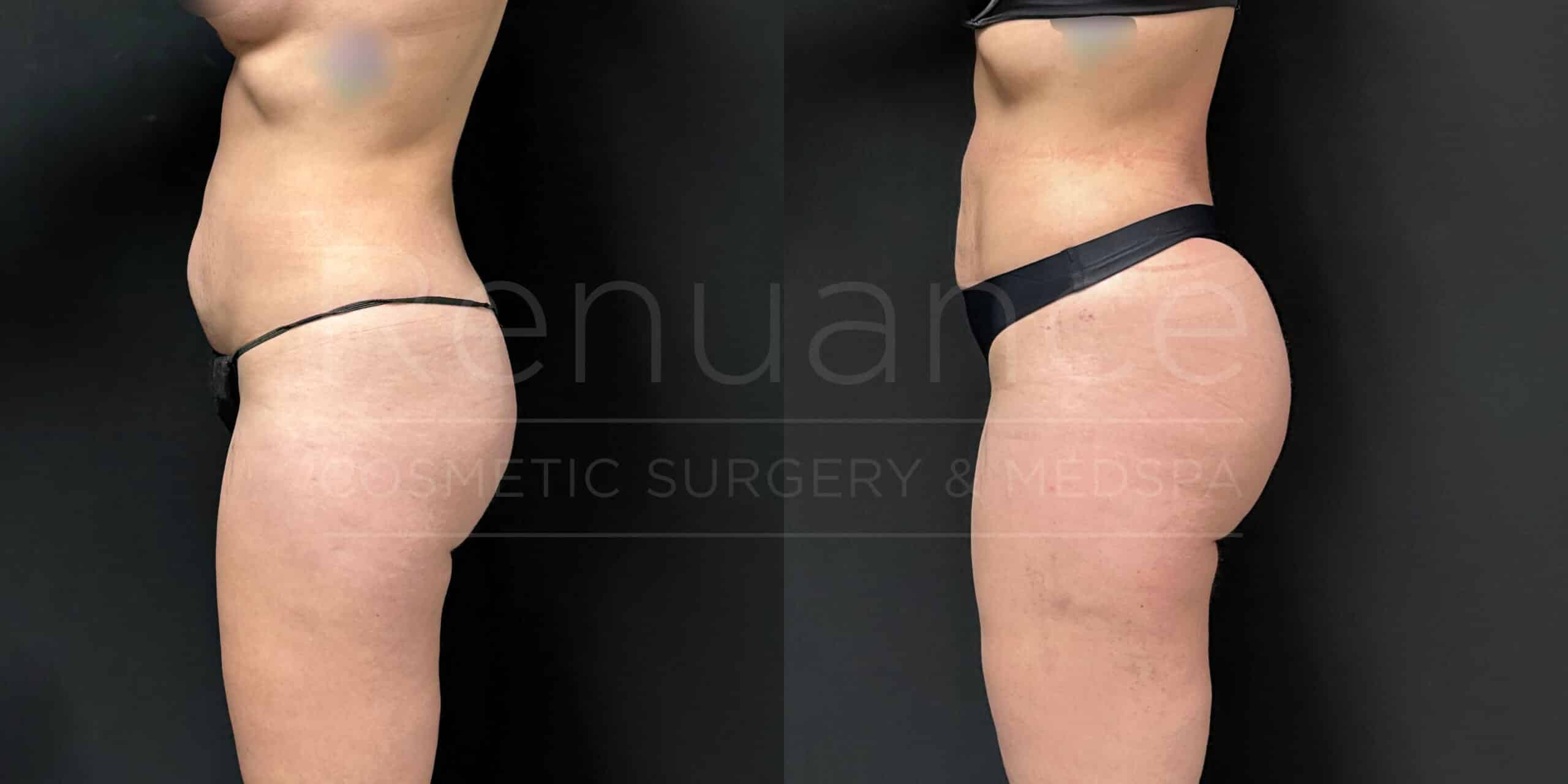 A side-by-side comparison shows the body of a person before and after undergoing a cosmetic procedure. Both images depict the individual wearing minimal black clothing items, standing in a side profile against a black background. The "after" image shows a more contoured shape, particularly in the midsection and thigh areas. Text is visible across the images that reads "NUANCE COSMETIC SURGERY & MEDSPA."