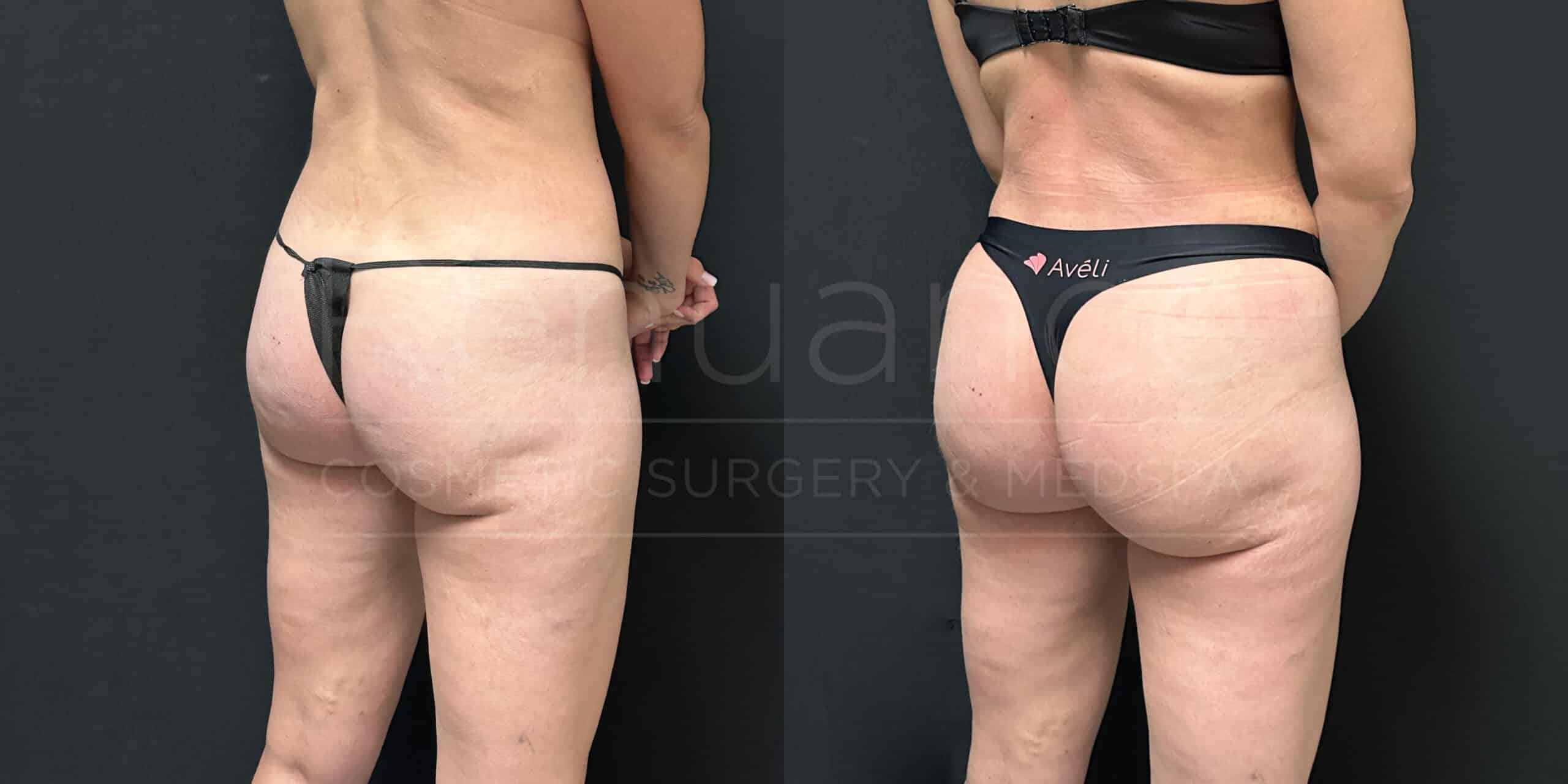 Before and after image of a woman’s lower body showing results from a cosmetic procedure targeting cellulite reduction. In the left image, the woman stands with visible cellulite on the buttocks and thighs, wearing minimal undergarments. In the right image, the woman shows smoother skin on the buttocks and thighs, wearing black undergarments.