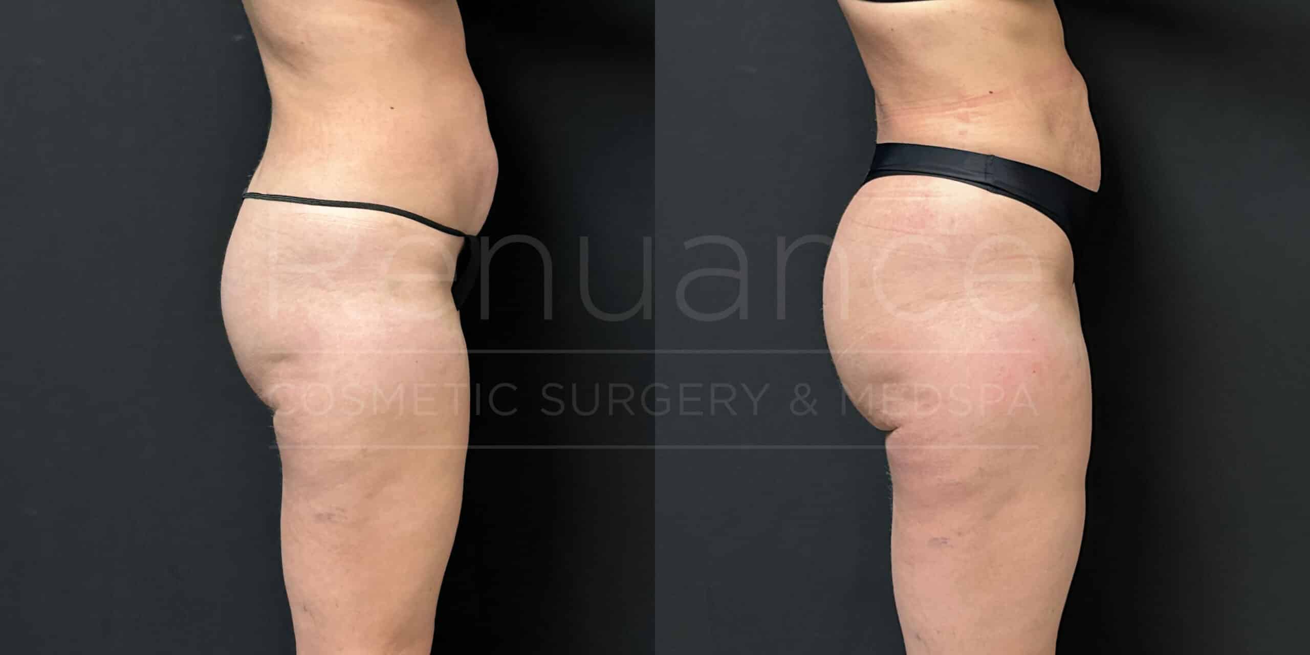 Side-by-side comparison of a woman's lower body before and after undergoing a cosmetic procedure. The left image shows the woman wearing a black thong, while the right image shows her wearing black underwear, with noticeable improvements in skin tightness and contour after the procedure. Both images are set against a black background.