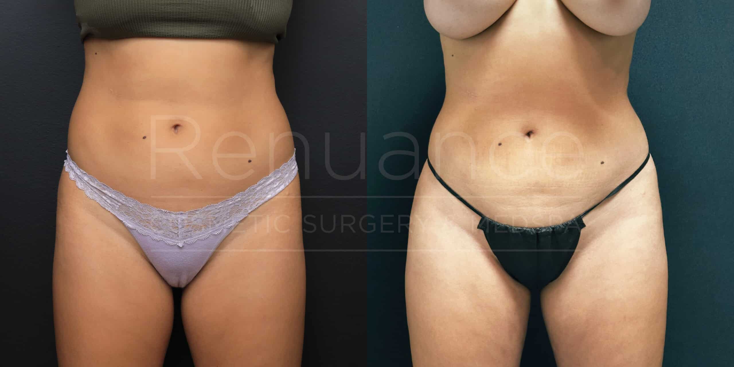 A side-by-side comparison image showing the torso of a person before and after a cosmetic procedure. The left side of the image shows the person wearing light purple underwear, and the right side shows the person wearing black underwear. The skin appears smoother and more toned in the after image on the right.