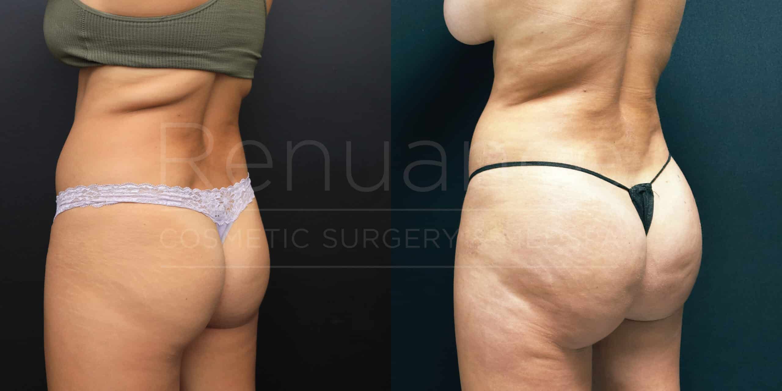 Side-by-side comparison of two images showing the back view of a person before and after undergoing a cosmetic procedure. The first image on the left displays the person before the procedure, while the second image on the right shows the results after the procedure. The differences in body contouring and skin appearance can be observed between the two images. The person is wearing different undergarments in each image, with the text "Renua Cosmetic Surgery" faintly visible in the center.