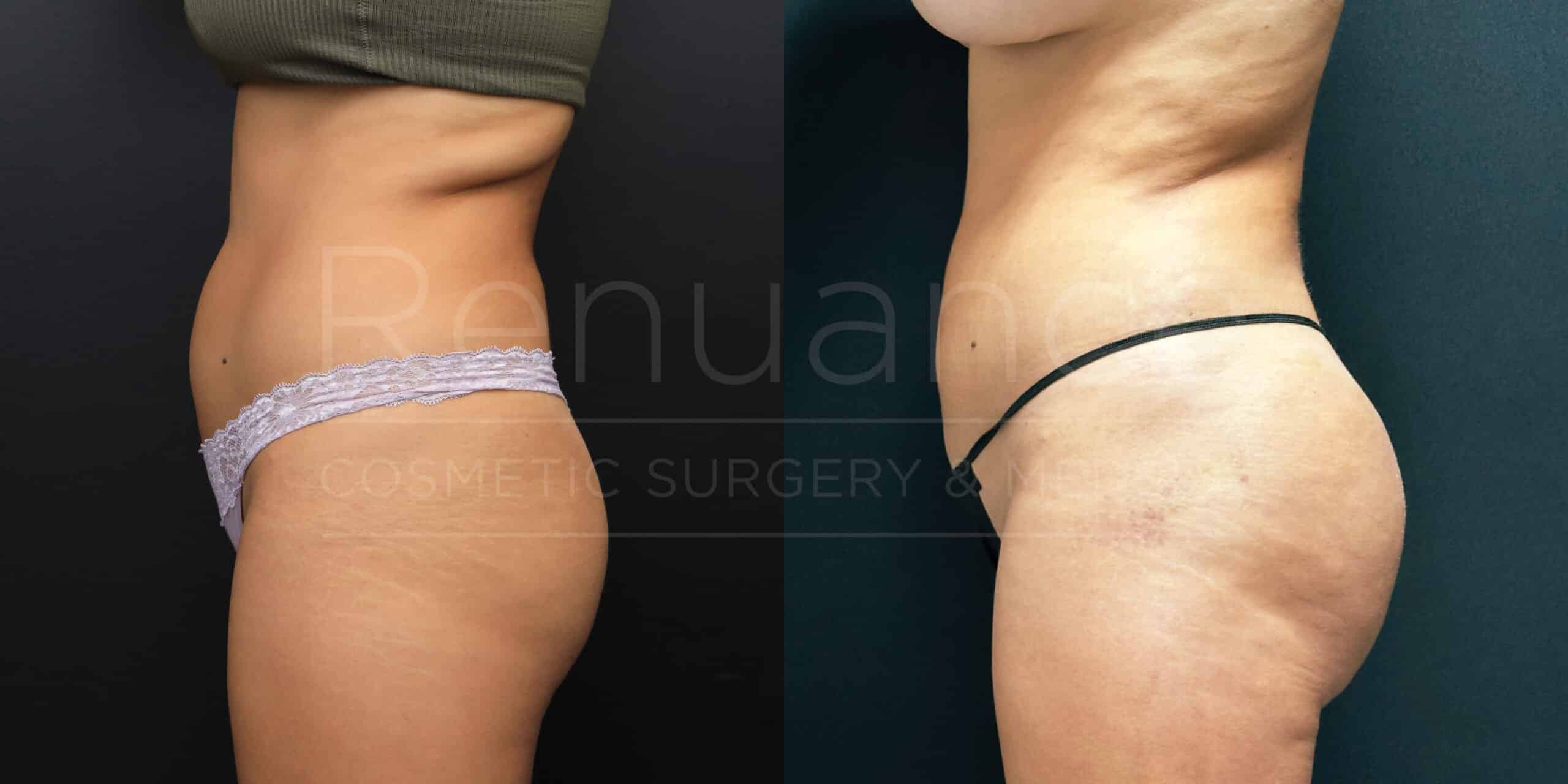 Side-by-side comparison of a person’s midsection before and after a cosmetic surgery procedure. The left image shows the individual before the surgery, with more noticeable contours and texture on the skin. The right image shows the individual after the surgery, with a smoother and more toned midsection. Both images focus on the abdominal and hip area. The text "Renuance COSMETIC SURGERY &" is overlaid on the images.