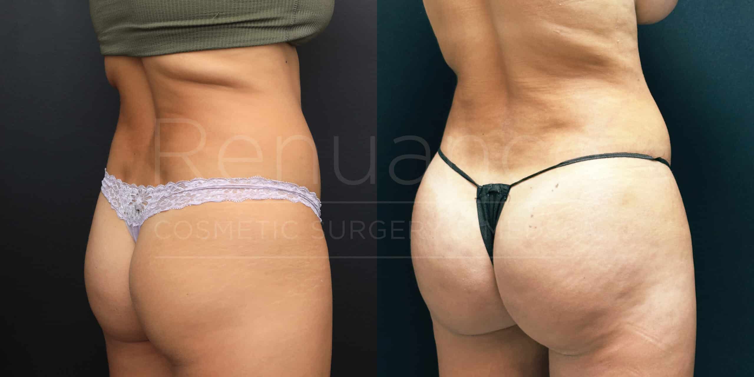 Side-by-side comparison of a person's lower back and buttock area. The left image shows them wearing light-colored lace underwear, and the right image shows them wearing black string underwear. The imagery is likely used for showcasing cosmetic surgery results.