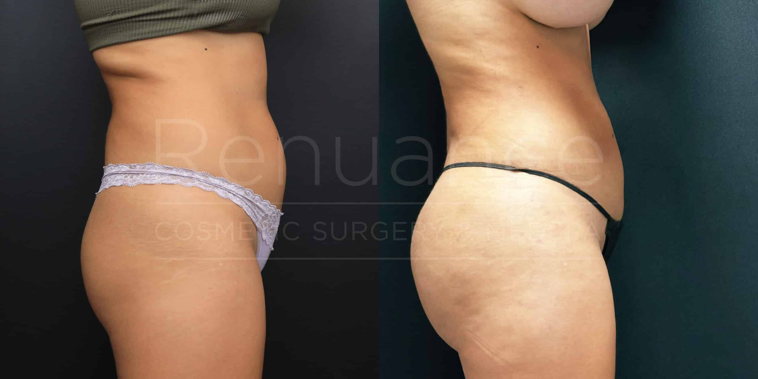 Side-by-side images showing a woman's torso in profile, before and after a cosmetic procedure. The left image shows her wearing a lace-trimmed, light-colored underwear, while the right image shows her in a dark-colored underwear. The after image demonstrates a noticeable change in her body's contour and tone.