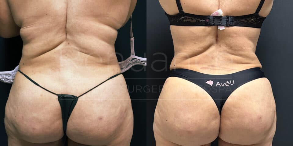 Comparison image showing the back view of a person before and after cosmetic surgery. The left side shows the "before" image, while the right side shows the "after" image. The person is wearing minimal underwear in both pictures, making the changes in body contour clearly visible. The "after" image shows a noticeable reduction in body fat and an overall smoother appearance of the skin. The word "Avéli" is visible on the person's underwear in the "after" image.