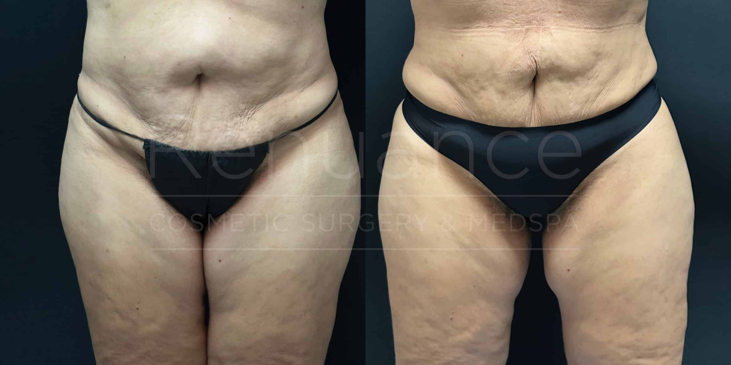 A before and after comparison image of a person's abdomen and thighs. The left side shows the "before" state, and the right side shows the "after" state post-surgery. The person is wearing black underwear in both images. The skin appears smoother and tighter in the "after" image.