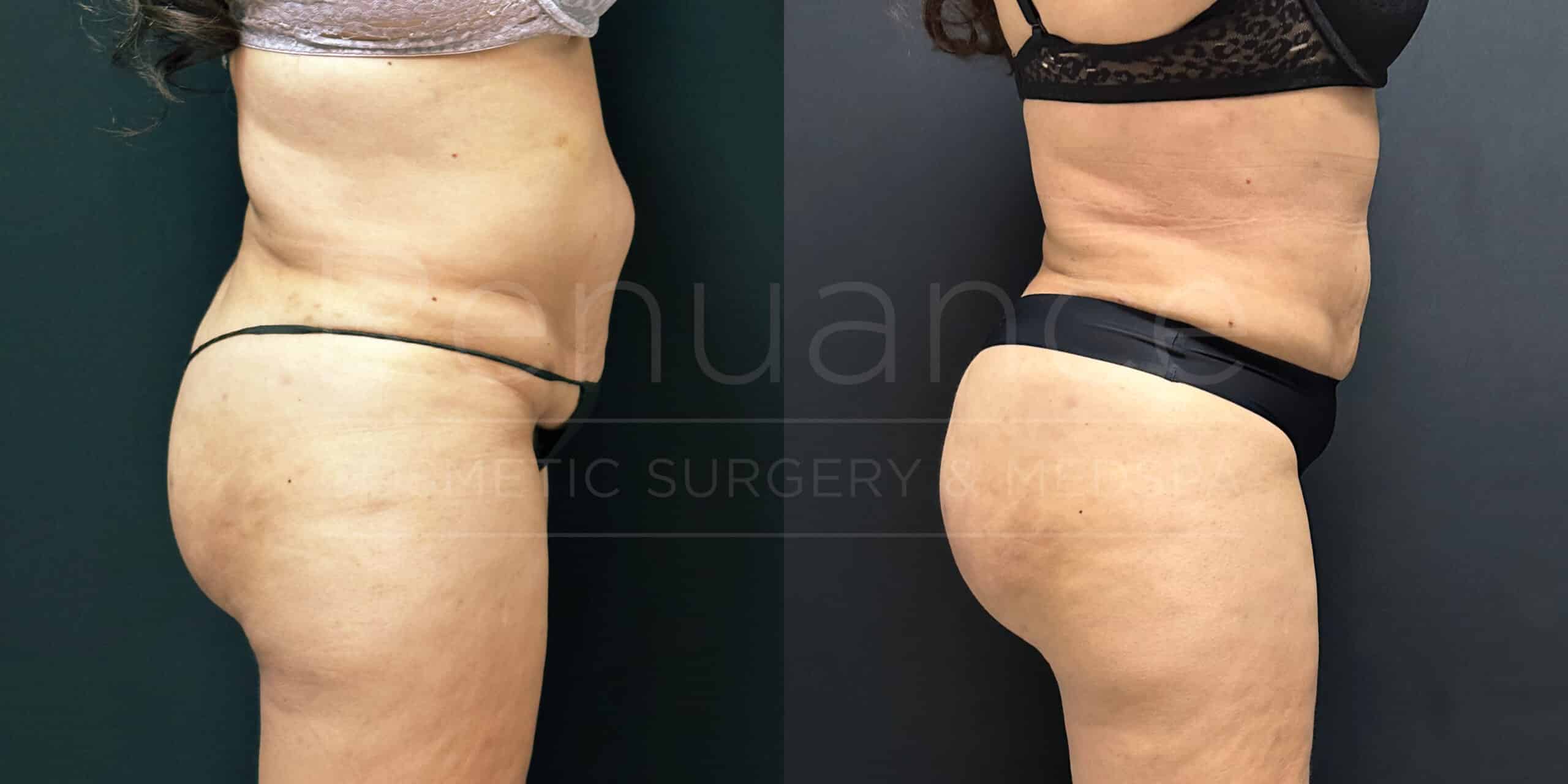 A side-by-side comparison photo showing a woman's lower body before and after a cosmetic procedure. The left image displays the woman wearing a light-colored bikini bottom and a bra, with noticeable excess fat and sagging skin around the abdomen and hip areas. The right image, taken after the procedure, reveals a more contoured and toned appearance with a reduction in excess fat and sagging skin. The woman is wearing a darker bikini bottom and a bra in the after image.