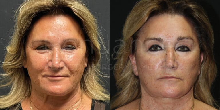 Two side-by-side images of the same middle-aged woman against a black background. The left image shows her before undergoing a cosmetic procedure with visible fine lines, wrinkles, and sagging skin around her eyes and cheeks. The right image shows her after the procedure, with smoother skin, fewer wrinkles, and more lifted features around the eyes and cheeks. Her hair appears the same in both images, styled in loose waves.