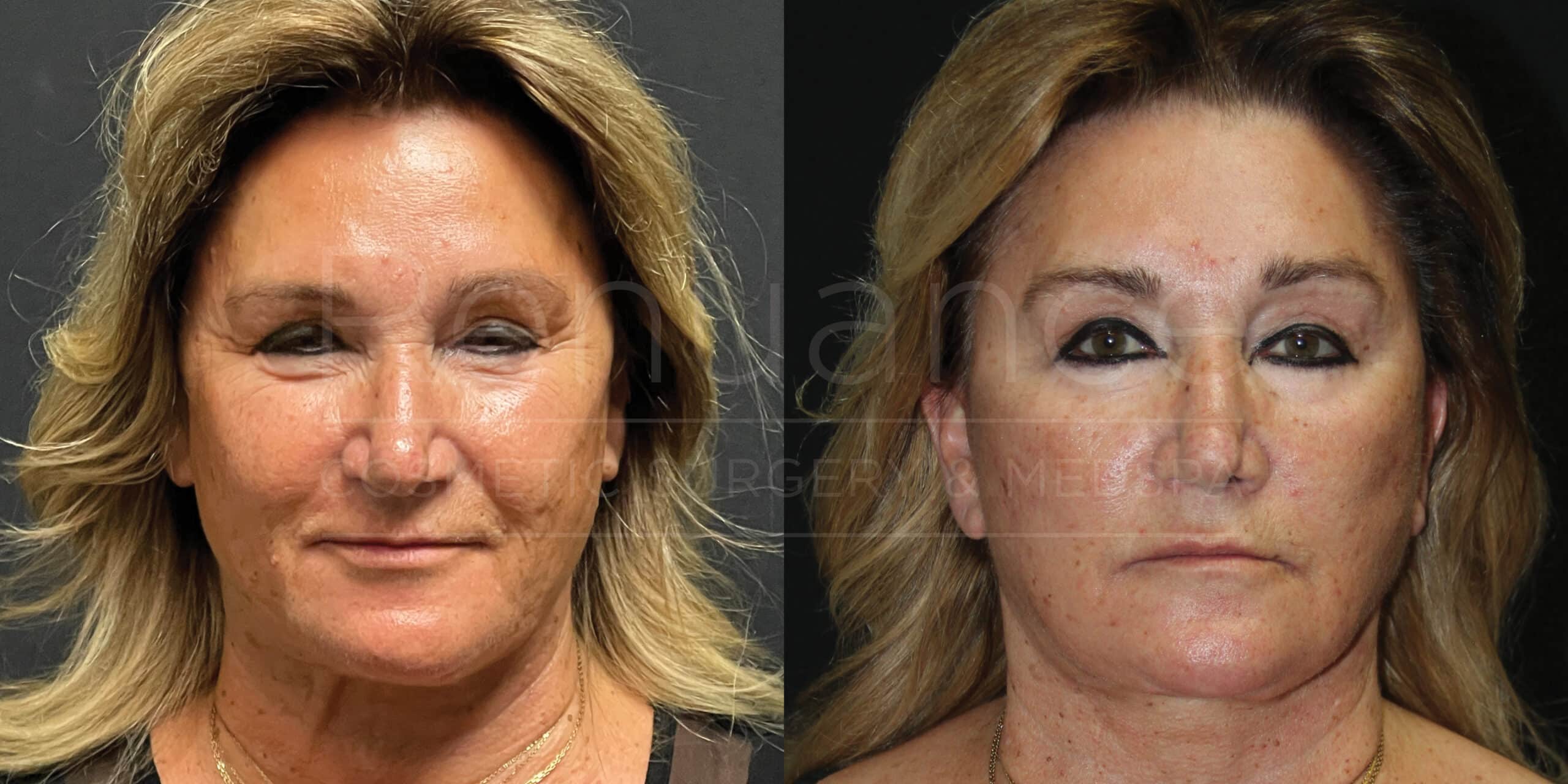 Two side-by-side images of the same middle-aged woman against a black background. The left image shows her before undergoing a cosmetic procedure with visible fine lines, wrinkles, and sagging skin around her eyes and cheeks. The right image shows her after the procedure, with smoother skin, fewer wrinkles, and more lifted features around the eyes and cheeks. Her hair appears the same in both images, styled in loose waves.