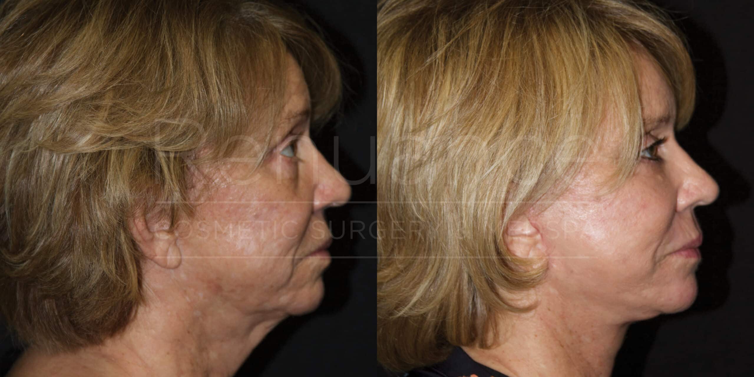 Side-by-side comparison images showing the profile of a woman before and after undergoing a cosmetic procedure. The left image shows the woman with visible signs of aging, including wrinkles and sagging skin. The right image shows the same woman after the procedure, with smoother and tighter skin, indicating a more youthful appearance.