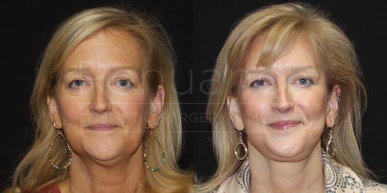 Side-by-side comparison photo of a woman before and after a cosmetic procedure. The left image shows the woman with visible signs of aging, including sagging skin and wrinkles, while the right image shows a more youthful appearance with tightened skin and a smoother complexion. She is wearing similar earrings in both images, and her blonde hair is styled similarly.